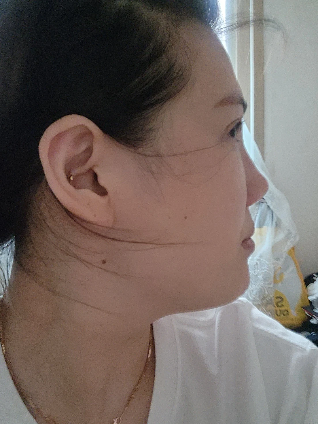 Revision inner-corner surgery and Wonder canthoplasty: six-month diary · Case 069 at Answer Plastic Surgery. Additional angled view — 2 weeks, revision inner-corner surgery and wonder canthoplasty at Answer Plastic Surgery (case 069).