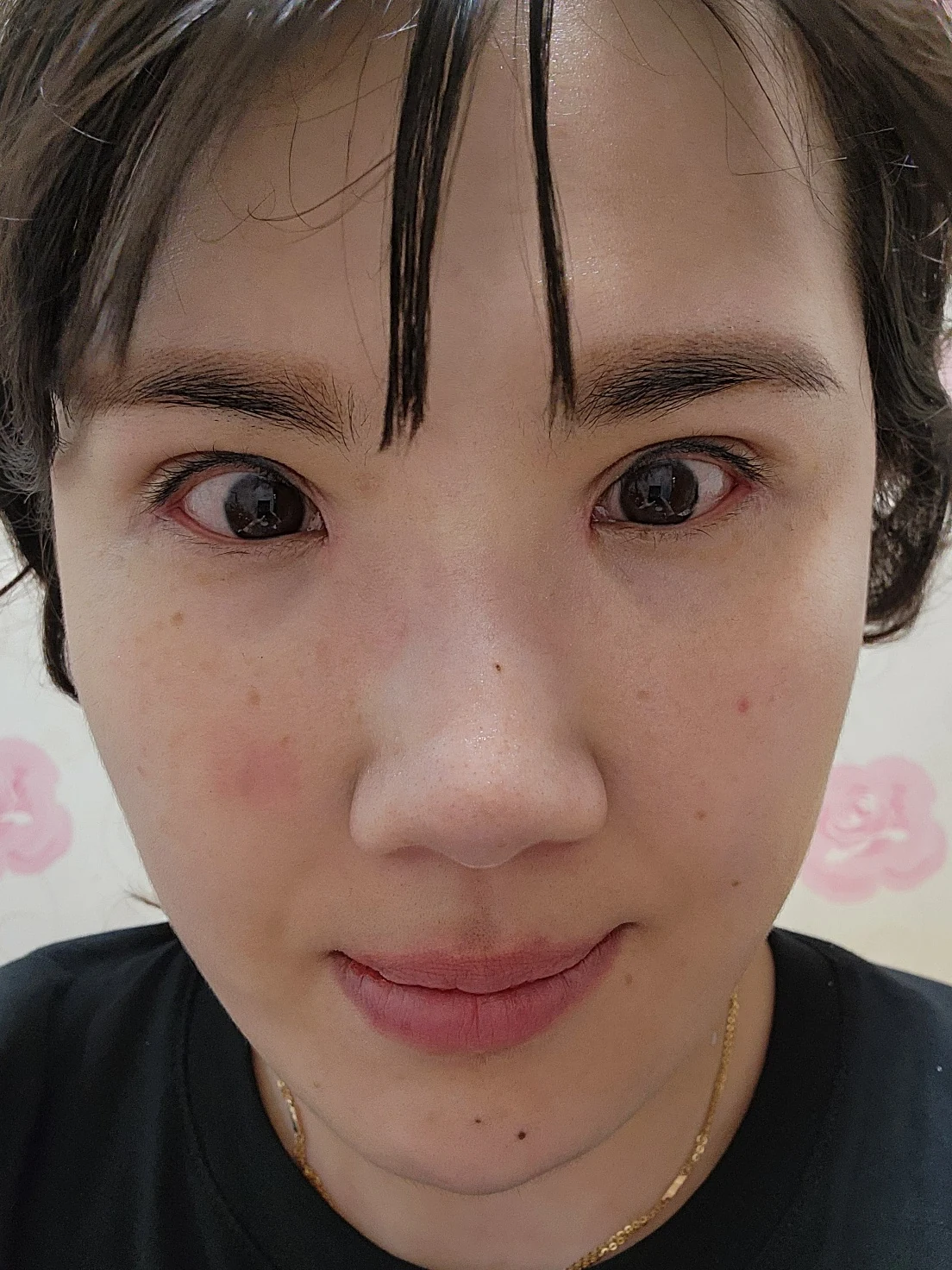 Revision inner-corner surgery and Wonder canthoplasty: six-month diary · Case 069 at Answer Plastic Surgery. Front view — 3 weeks, revision inner-corner surgery and wonder canthoplasty at Answer Plastic Surgery (case 069).