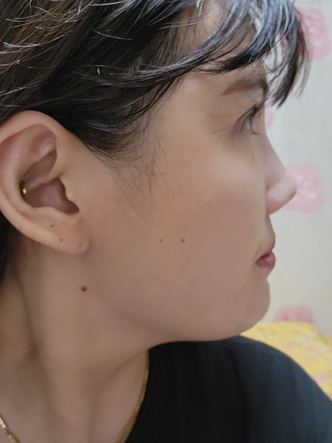 Revision inner-corner surgery and Wonder canthoplasty: six-month diary · Case 069 at Answer Plastic Surgery. Additional angled view — 3 weeks, revision inner-corner surgery and wonder canthoplasty at Answer Plastic Surgery (case 069).