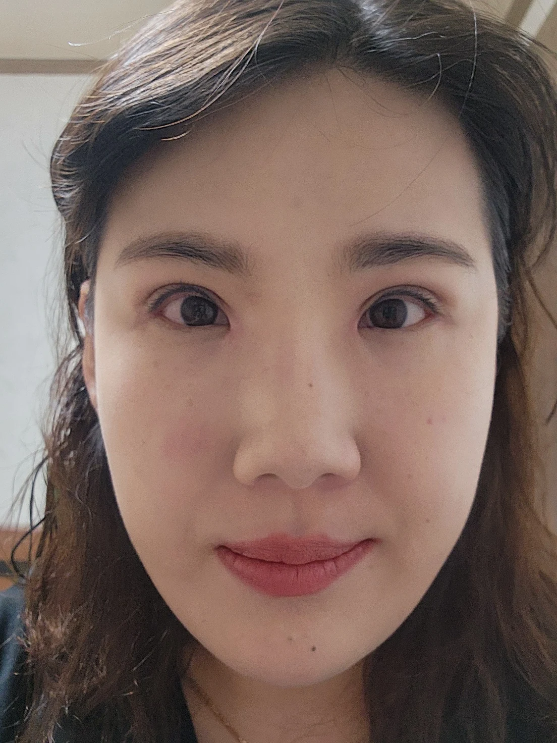 Revision inner-corner surgery and Wonder canthoplasty: six-month diary · Case 069 at Answer Plastic Surgery. Front view — 1 month, revision inner-corner surgery and wonder canthoplasty at Answer Plastic Surgery (case 069).