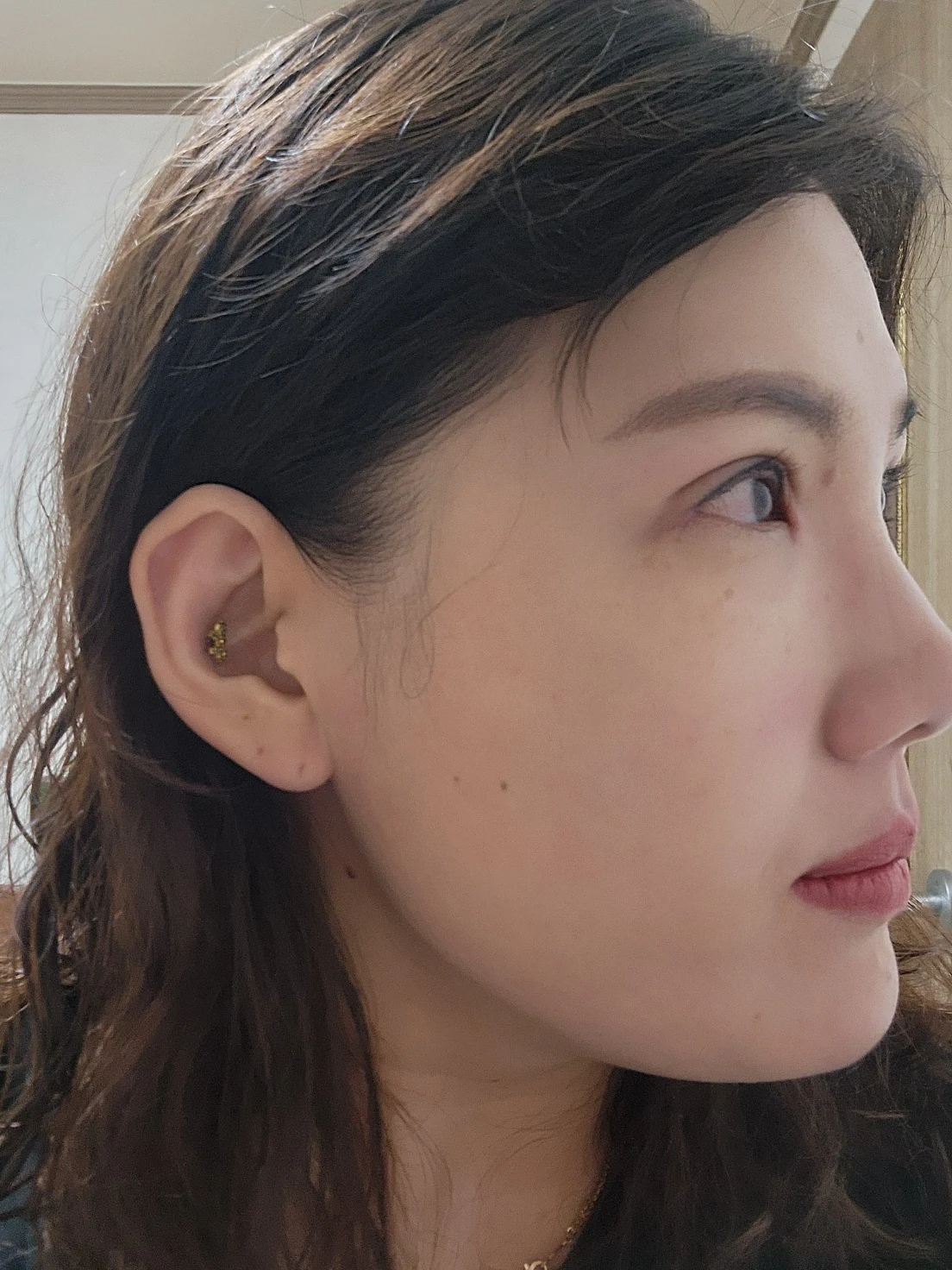 Revision inner-corner surgery and Wonder canthoplasty: six-month diary · Case 069 at Answer Plastic Surgery. Angled view — 1 month, revision inner-corner surgery and wonder canthoplasty at Answer Plastic Surgery (case 069).