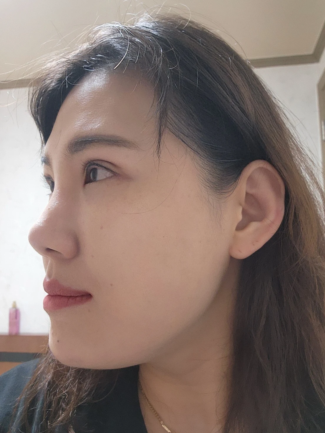 Revision inner-corner surgery and Wonder canthoplasty: six-month diary · Case 069 at Answer Plastic Surgery. Additional angled view — 1 month, revision inner-corner surgery and wonder canthoplasty at Answer Plastic Surgery (case 069).