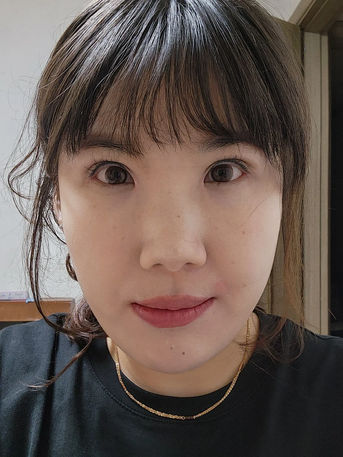 Revision inner-corner surgery and Wonder canthoplasty: six-month diary · Case 069 at Answer Plastic Surgery. Front view — 2 months, revision inner-corner surgery and wonder canthoplasty at Answer Plastic Surgery (case 069).