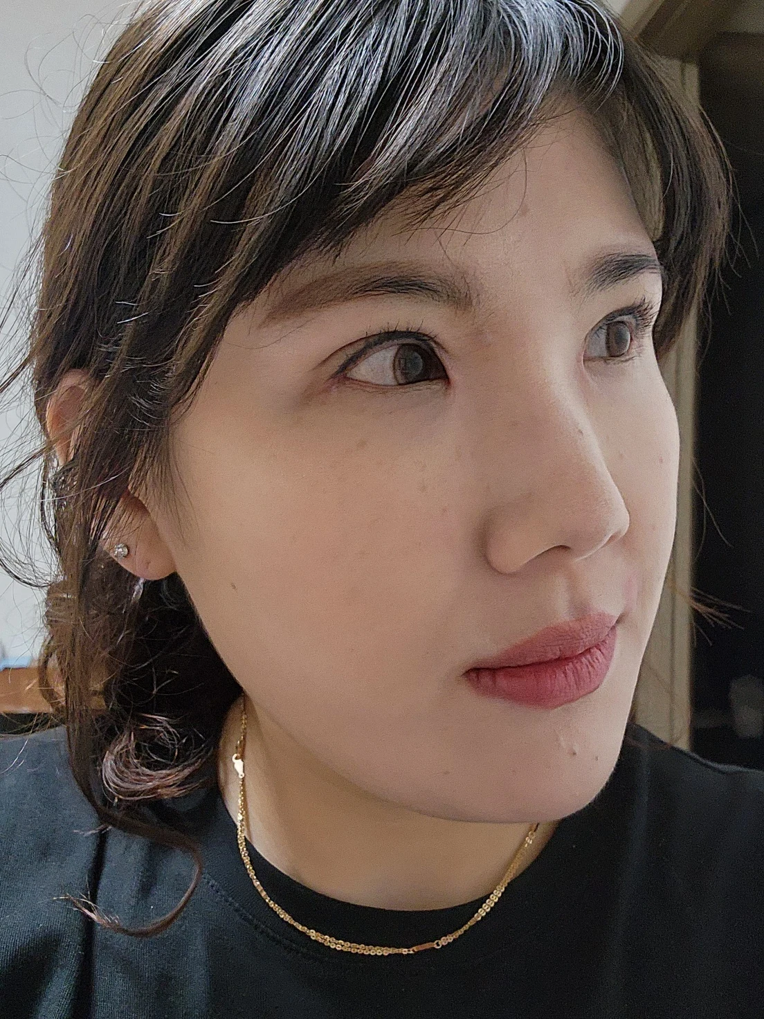 Revision inner-corner surgery and Wonder canthoplasty: six-month diary · Case 069 at Answer Plastic Surgery. Angled view — 2 months, revision inner-corner surgery and wonder canthoplasty at Answer Plastic Surgery (case 069).