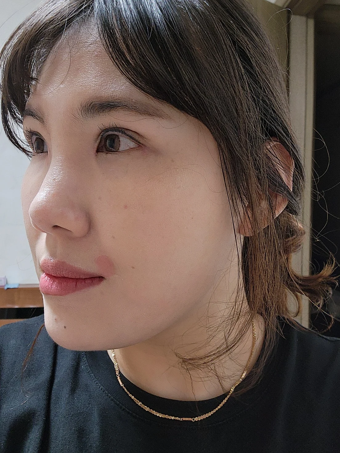 Revision inner-corner surgery and Wonder canthoplasty: six-month diary · Case 069 at Answer Plastic Surgery. Additional angled view — 2 months, revision inner-corner surgery and wonder canthoplasty at Answer Plastic Surgery (case 069).