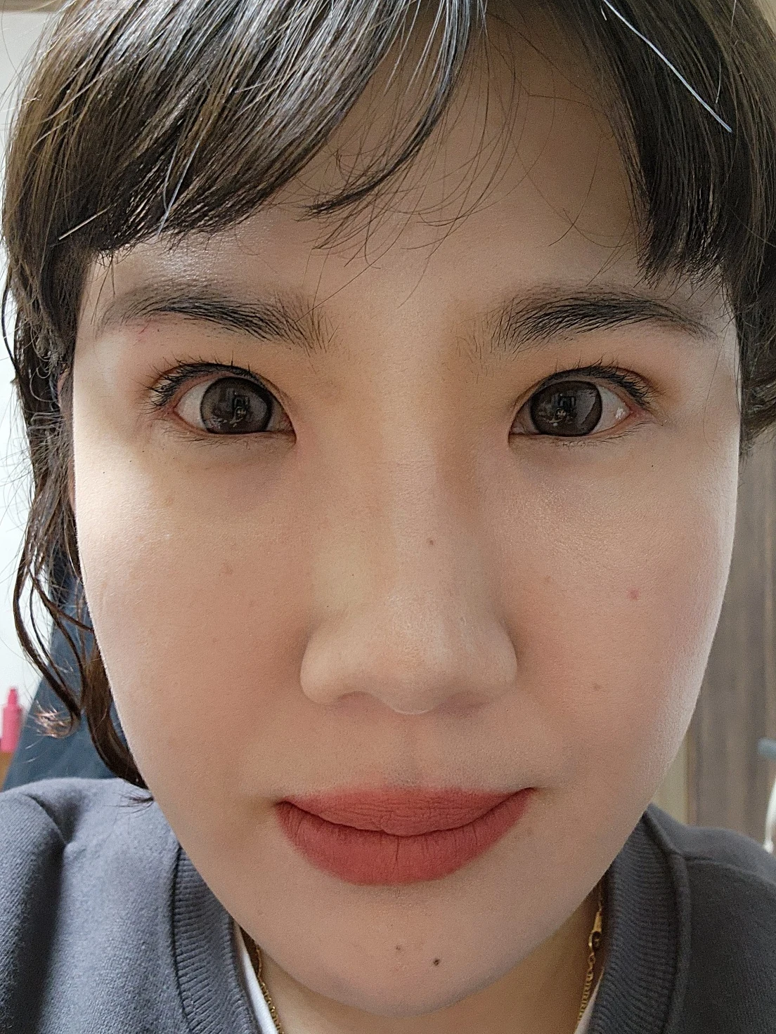 Revision inner-corner surgery and Wonder canthoplasty: six-month diary · Case 069 at Answer Plastic Surgery. Front view — 3 months, revision inner-corner surgery and wonder canthoplasty at Answer Plastic Surgery (case 069).