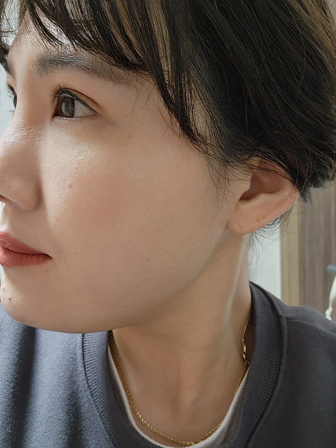Revision inner-corner surgery and Wonder canthoplasty: six-month diary · Case 069 at Answer Plastic Surgery. Additional angled view — 3 months, revision inner-corner surgery and wonder canthoplasty at Answer Plastic Surgery (case 069).