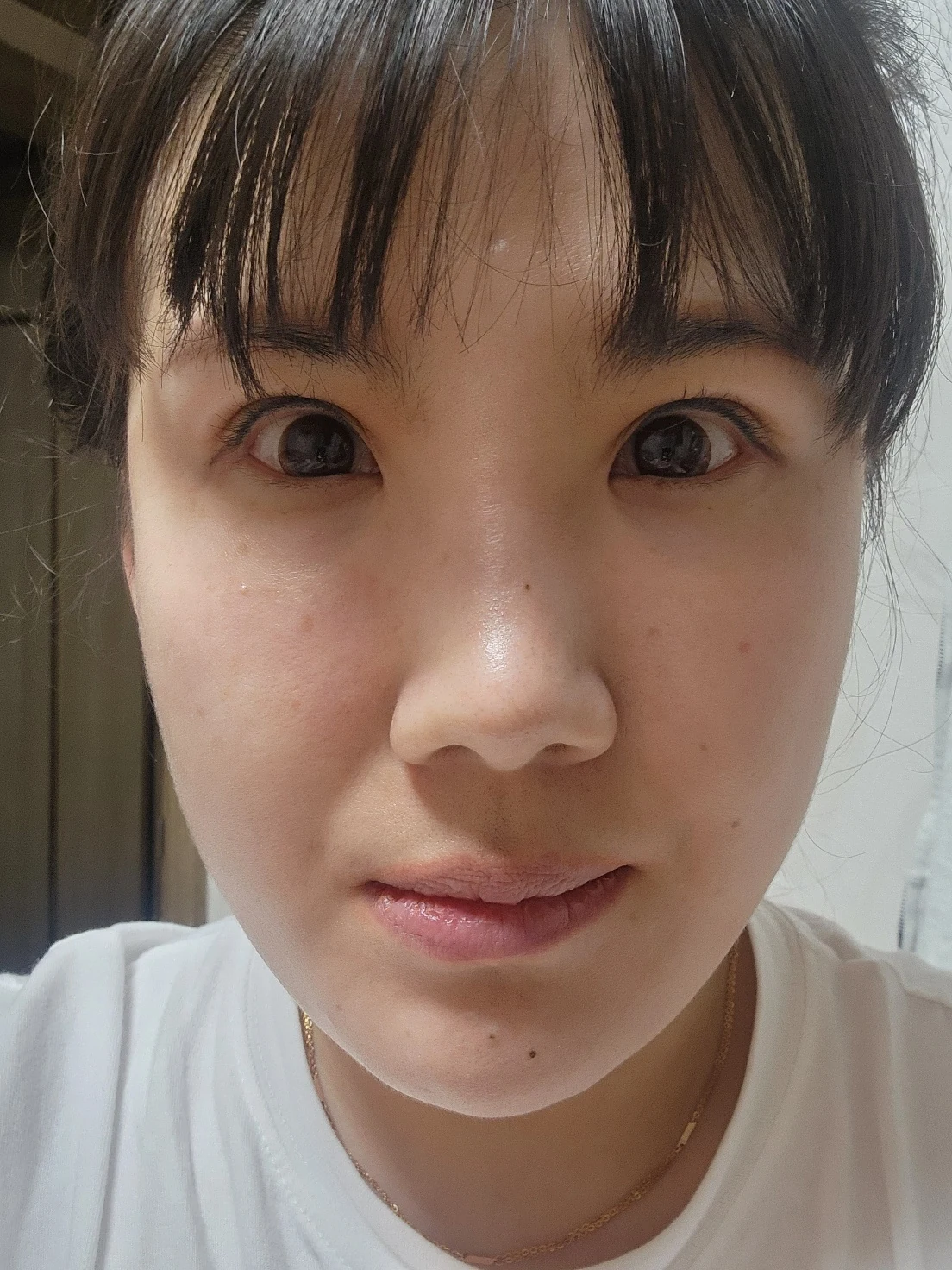 Revision inner-corner surgery and Wonder canthoplasty: six-month diary · Case 069 at Answer Plastic Surgery. Front view — 6 months, revision inner-corner surgery and wonder canthoplasty at Answer Plastic Surgery (case 069).