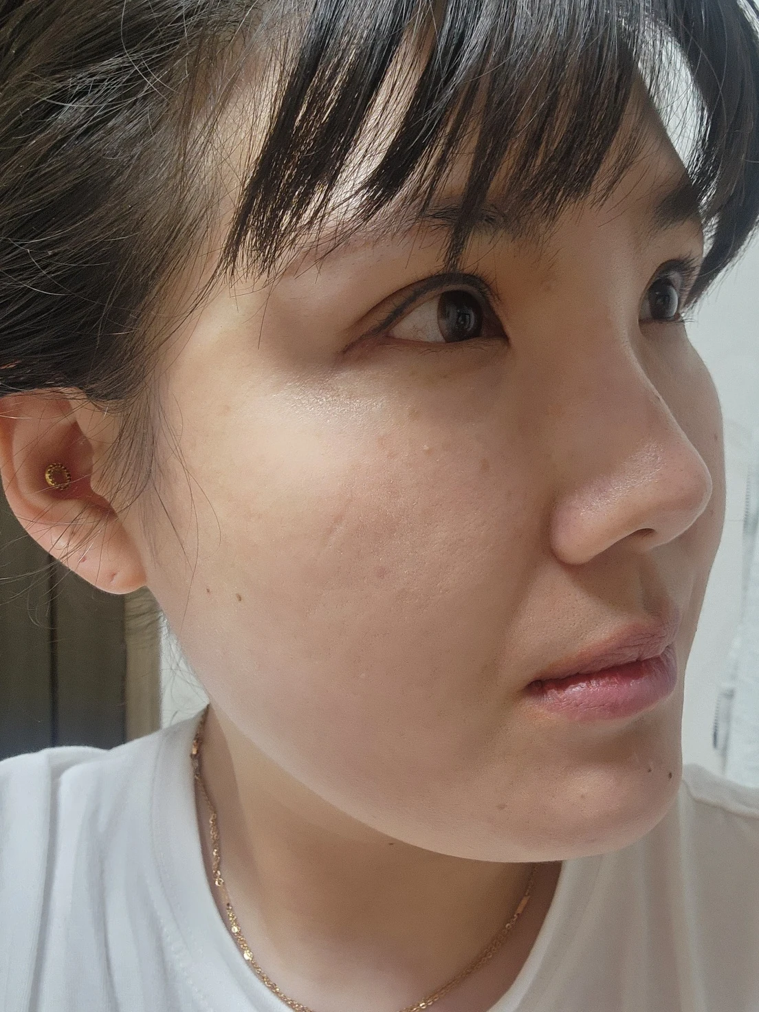 Revision inner-corner surgery and Wonder canthoplasty: six-month diary · Case 069 at Answer Plastic Surgery. Angled view — 6 months, revision inner-corner surgery and wonder canthoplasty at Answer Plastic Surgery (case 069).
