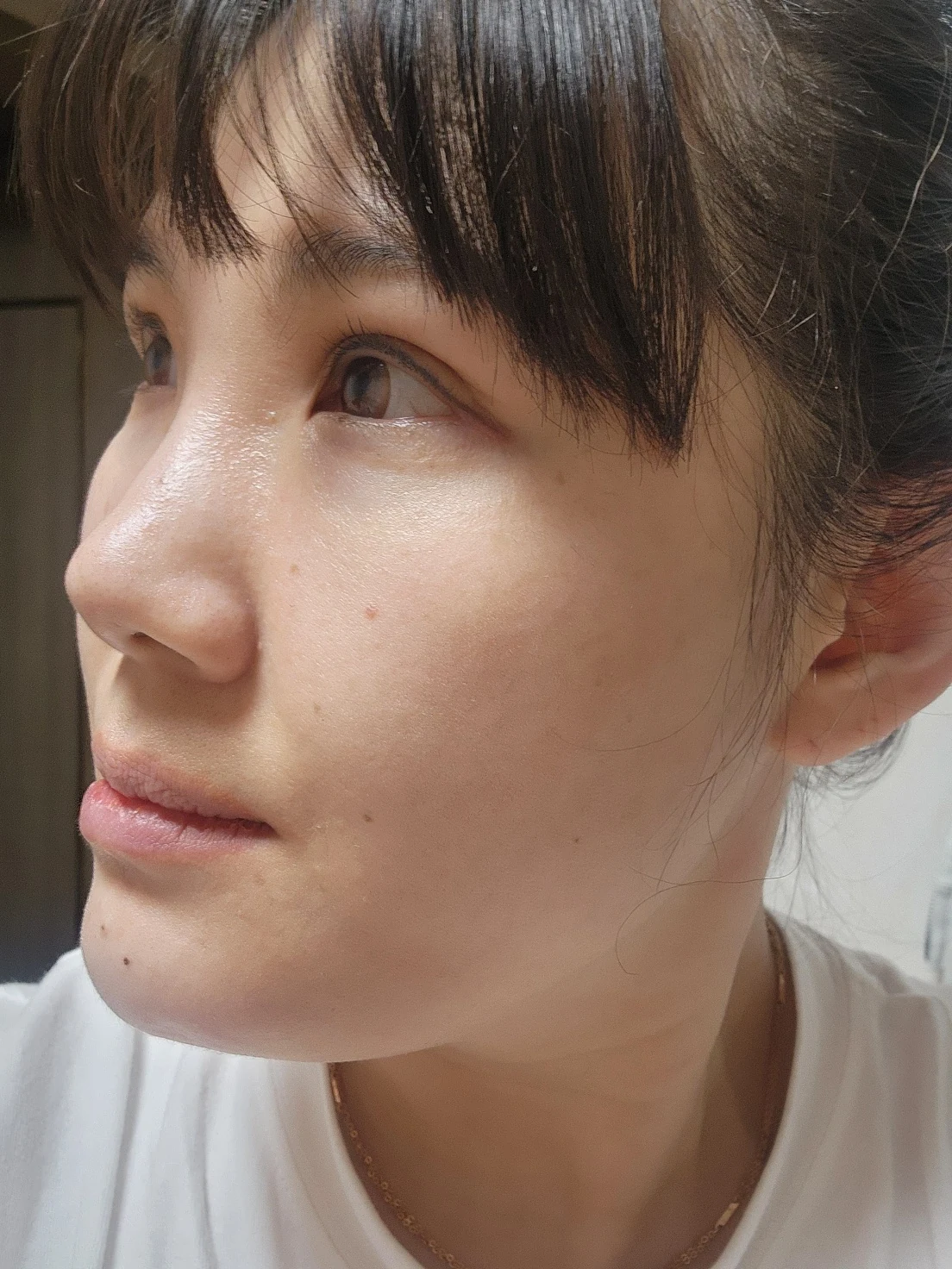 Revision inner-corner surgery and Wonder canthoplasty: six-month diary · Case 069 at Answer Plastic Surgery. Additional angled view — 6 months, revision inner-corner surgery and wonder canthoplasty at Answer Plastic Surgery (case 069).
