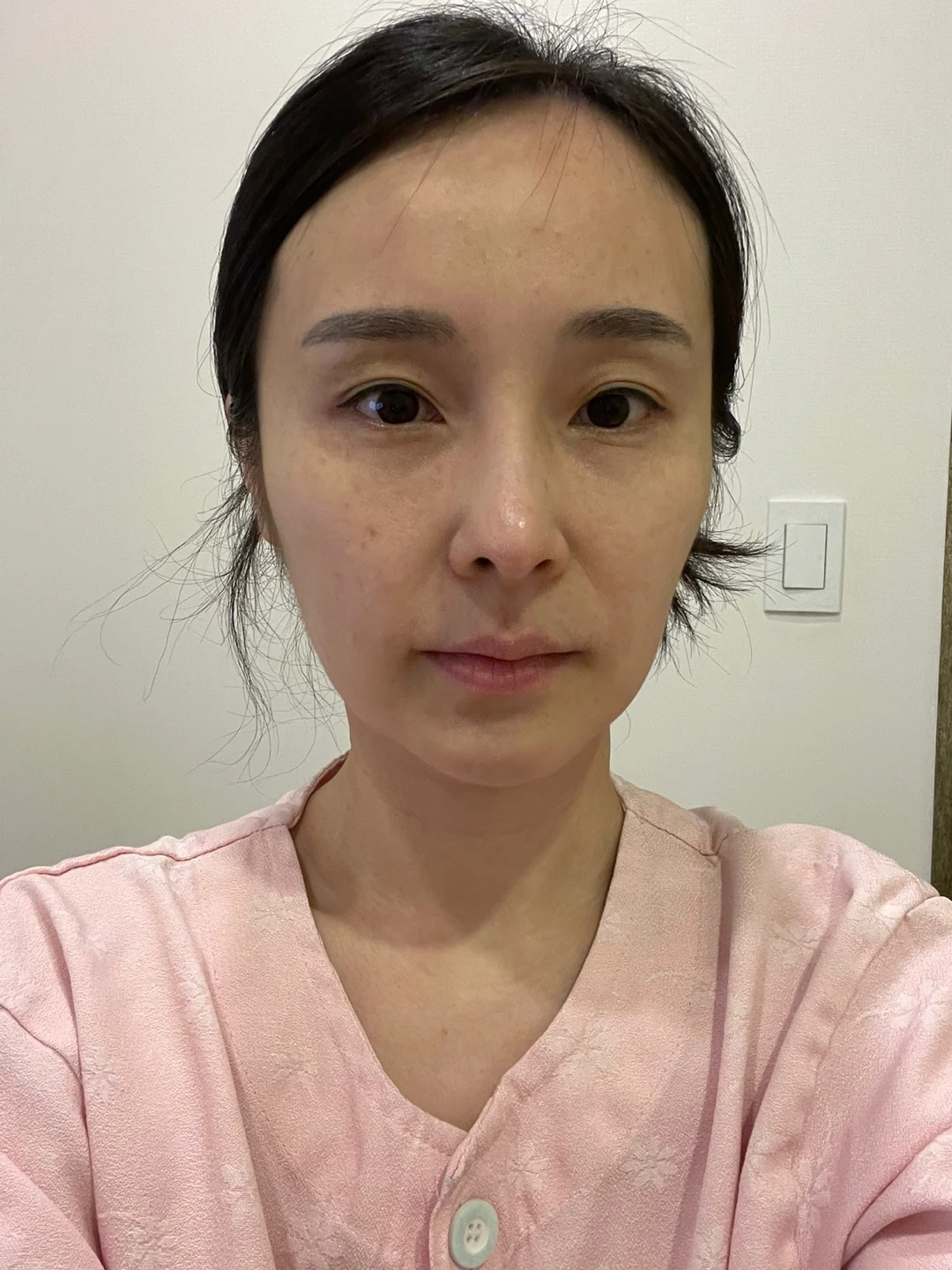 Under-eye fat surgery and Wonder canthoplasty: six-month diary · Case 070 at Answer Plastic Surgery. Front view — before, under-eye fat surgery and wonder canthoplasty at Answer Plastic Surgery (case 070).
