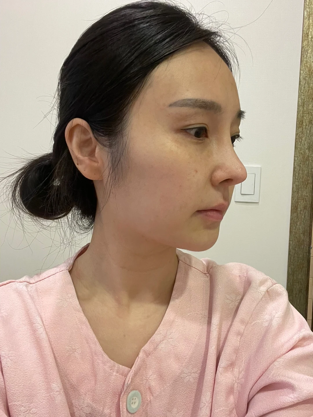 Under-eye fat surgery and Wonder canthoplasty: six-month diary · Case 070 at Answer Plastic Surgery. Angled view — before, under-eye fat surgery and wonder canthoplasty at Answer Plastic Surgery (case 070).