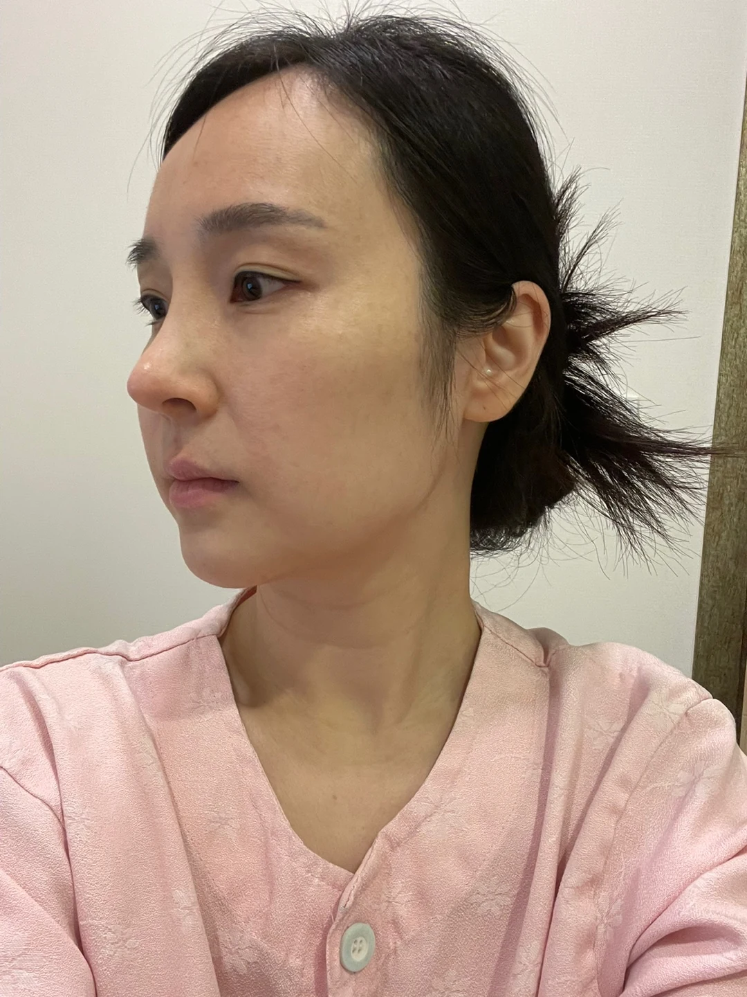 Under-eye fat surgery and Wonder canthoplasty: six-month diary · Case 070 at Answer Plastic Surgery. Additional angled view — before, under-eye fat surgery and wonder canthoplasty at Answer Plastic Surgery (case 070).