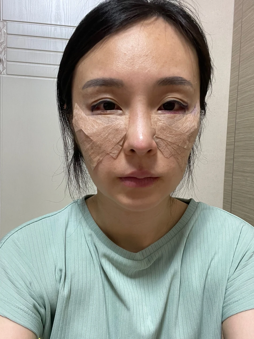 Under-eye fat surgery and Wonder canthoplasty: six-month diary · Case 070 at Answer Plastic Surgery. Front view — day of surgery, under-eye fat surgery and wonder canthoplasty at Answer Plastic Surgery (case 070).