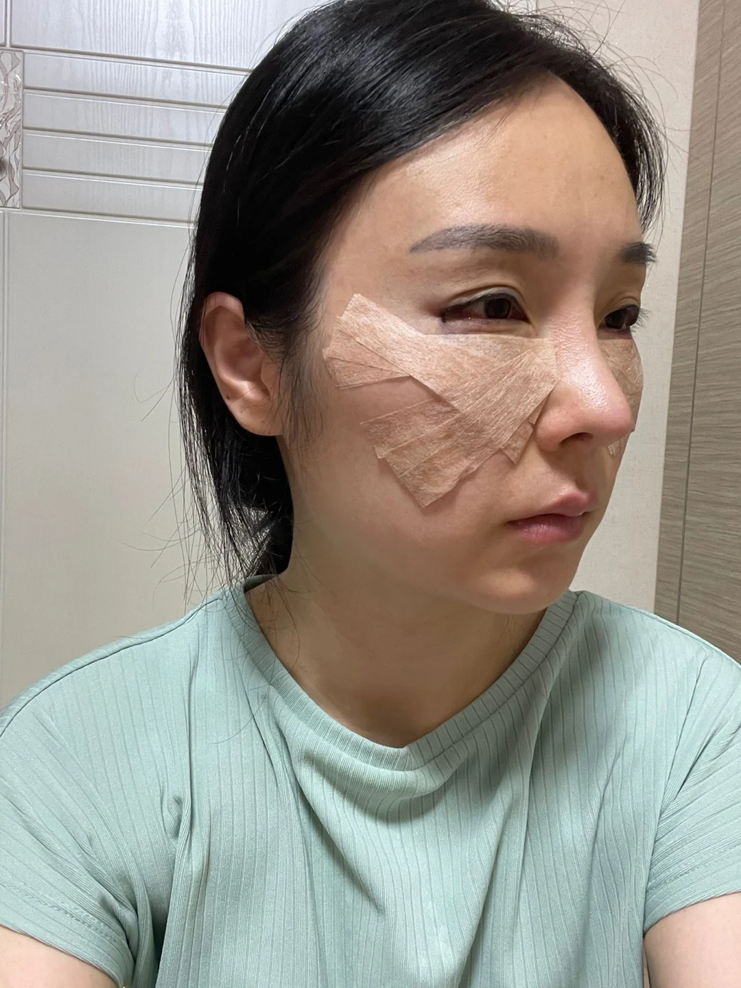 Under-eye fat surgery and Wonder canthoplasty: six-month diary · Case 070 at Answer Plastic Surgery. Angled view — day of surgery, under-eye fat surgery and wonder canthoplasty at Answer Plastic Surgery (case 070).