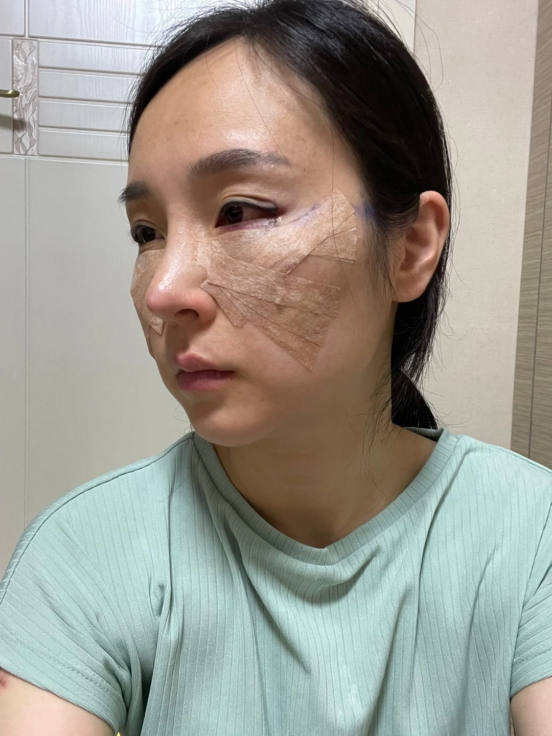 Under-eye fat surgery and Wonder canthoplasty: six-month diary · Case 070 at Answer Plastic Surgery. Additional angled view — day of surgery, under-eye fat surgery and wonder canthoplasty at Answer Plastic Surgery (case 070).