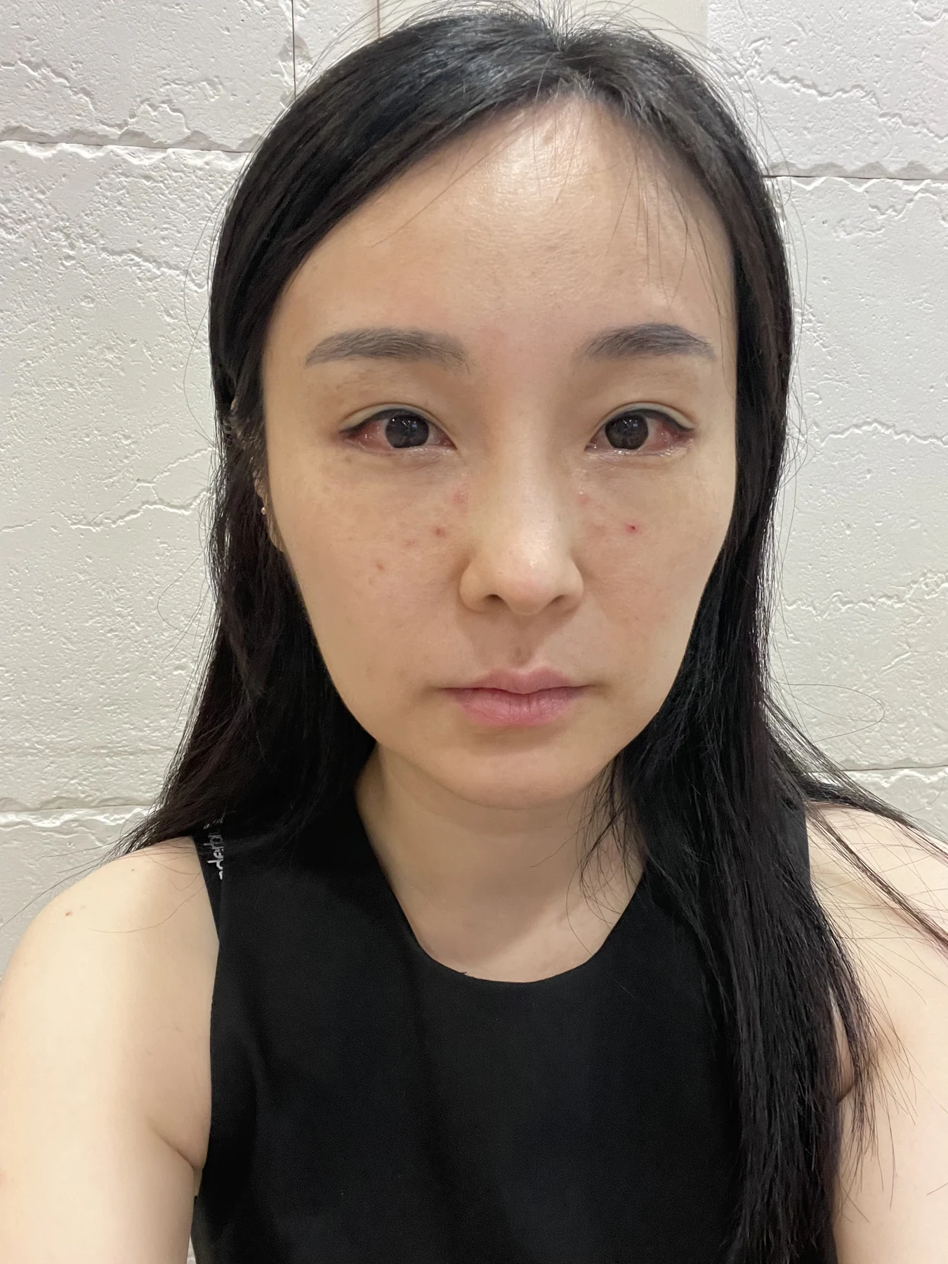 Under-eye fat surgery and Wonder canthoplasty: six-month diary · Case 070 at Answer Plastic Surgery. Front view — 1 week, under-eye fat surgery and wonder canthoplasty at Answer Plastic Surgery (case 070).