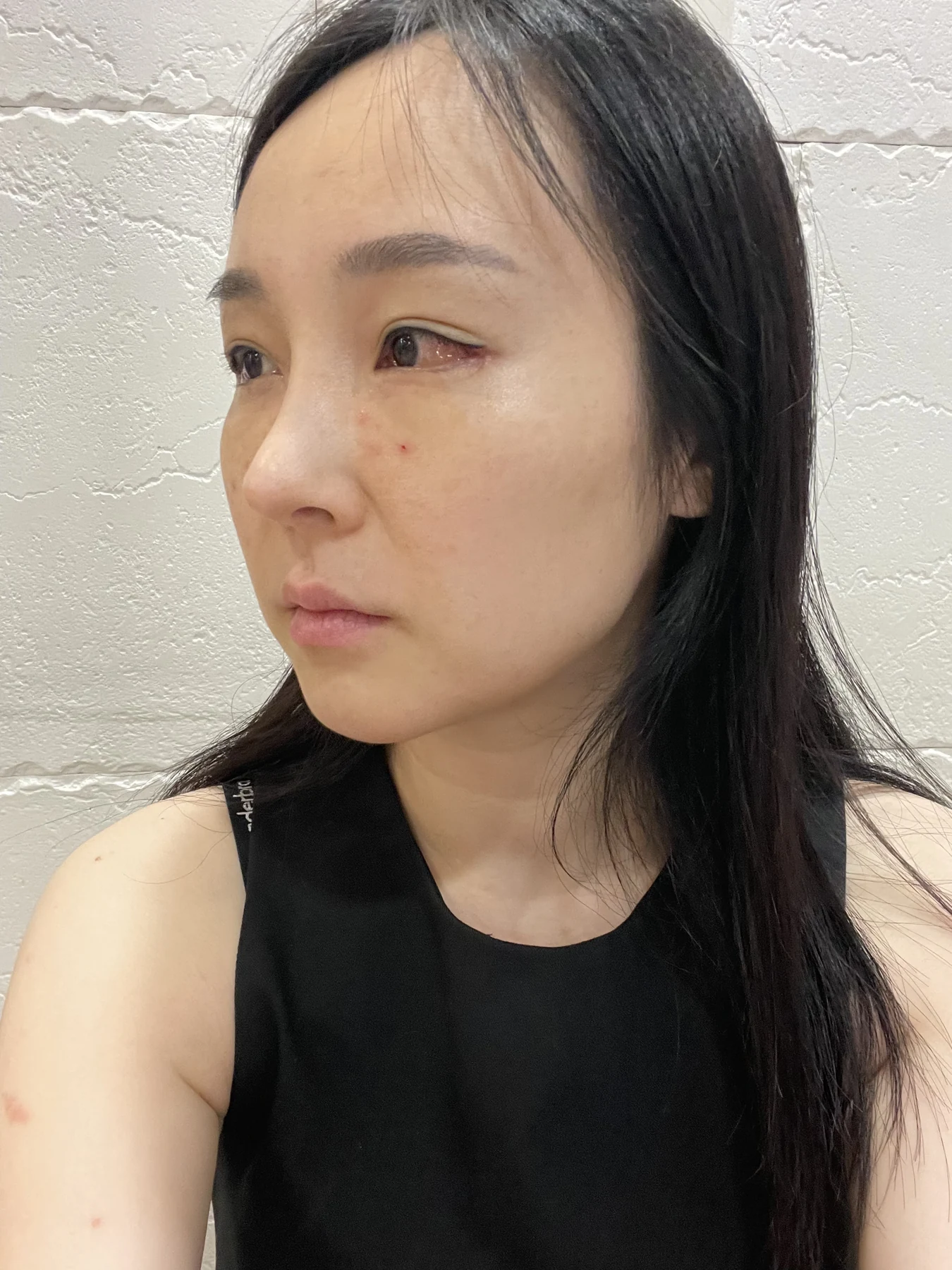 Under-eye fat surgery and Wonder canthoplasty: six-month diary · Case 070 at Answer Plastic Surgery. Angled view — 1 week, under-eye fat surgery and wonder canthoplasty at Answer Plastic Surgery (case 070).