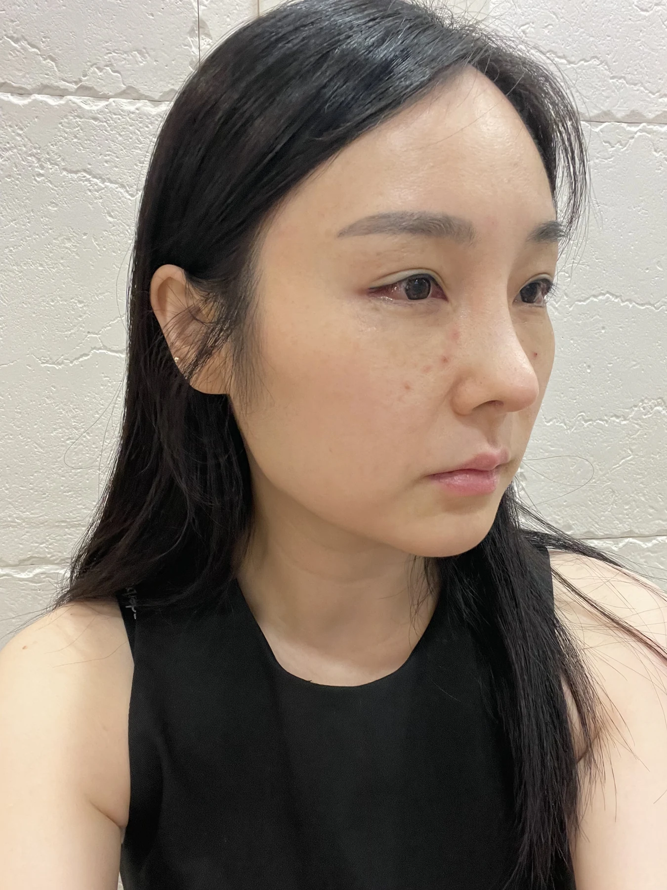 Under-eye fat surgery and Wonder canthoplasty: six-month diary · Case 070 at Answer Plastic Surgery. Additional angled view — 1 week, under-eye fat surgery and wonder canthoplasty at Answer Plastic Surgery (case 070).