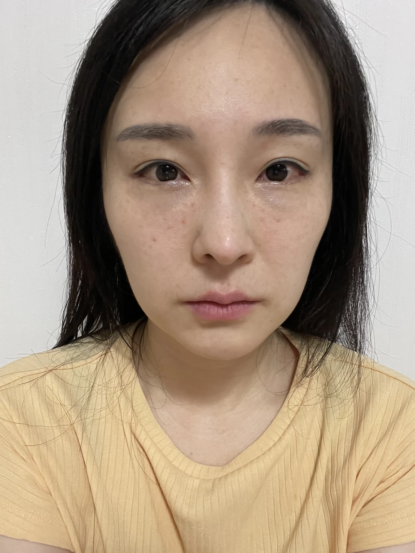 Under-eye fat surgery and Wonder canthoplasty: six-month diary · Case 070 at Answer Plastic Surgery. Front view — 2 weeks, under-eye fat surgery and wonder canthoplasty at Answer Plastic Surgery (case 070).