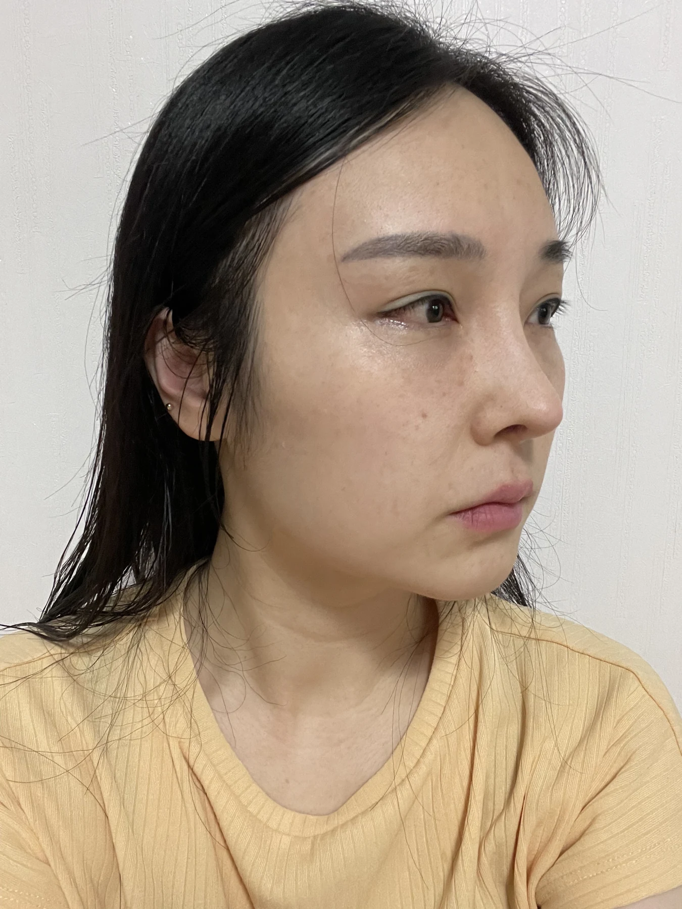 Under-eye fat surgery and Wonder canthoplasty: six-month diary · Case 070 at Answer Plastic Surgery. Angled view — 2 weeks, under-eye fat surgery and wonder canthoplasty at Answer Plastic Surgery (case 070).