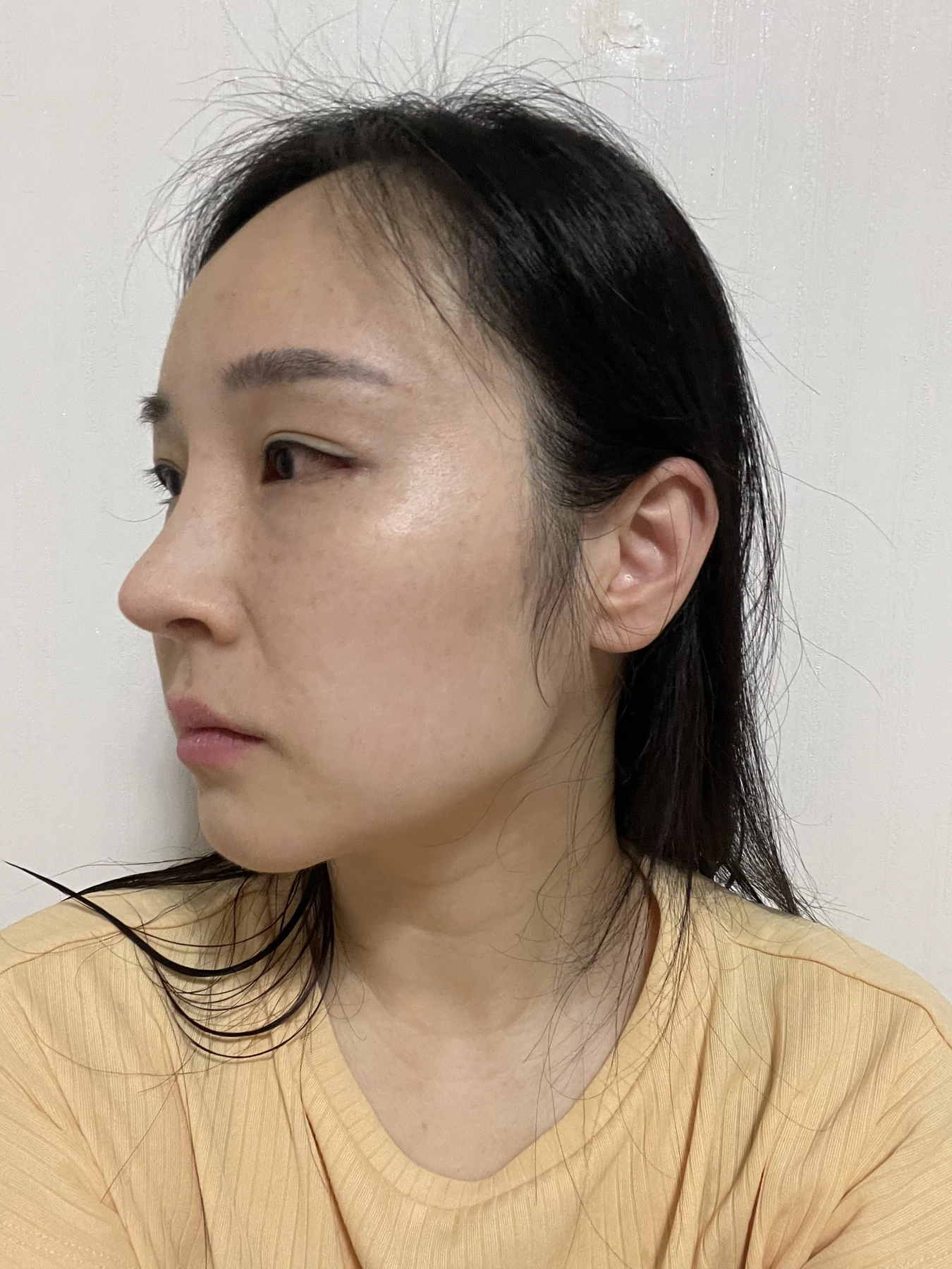 Under-eye fat surgery and Wonder canthoplasty: six-month diary · Case 070 at Answer Plastic Surgery. Additional angled view — 2 weeks, under-eye fat surgery and wonder canthoplasty at Answer Plastic Surgery (case 070).