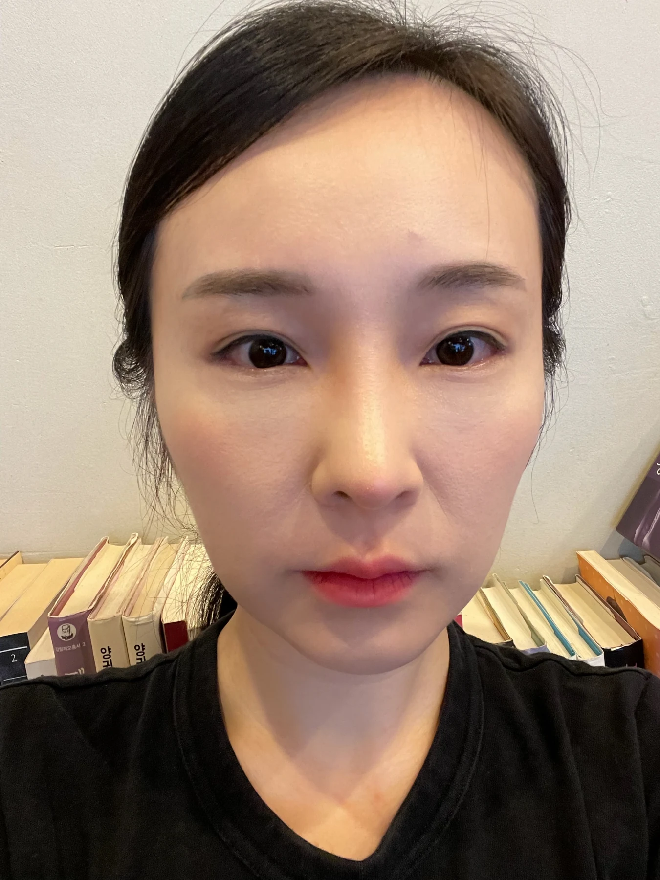 Under-eye fat surgery and Wonder canthoplasty: six-month diary · Case 070 at Answer Plastic Surgery. Front view — 1 month, under-eye fat surgery and wonder canthoplasty at Answer Plastic Surgery (case 070).