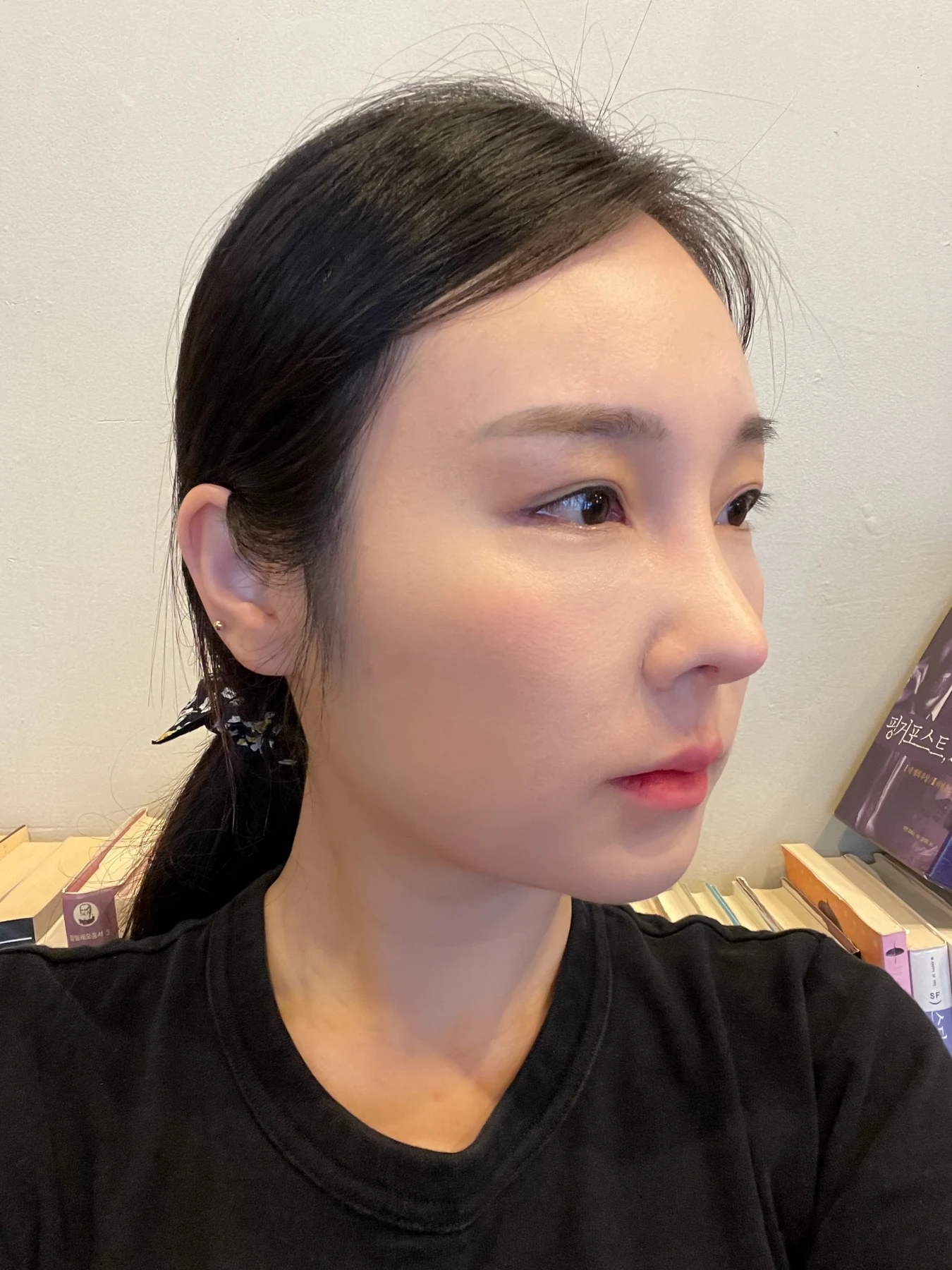 Under-eye fat surgery and Wonder canthoplasty: six-month diary · Case 070 at Answer Plastic Surgery. Angled view — 1 month, under-eye fat surgery and wonder canthoplasty at Answer Plastic Surgery (case 070).
