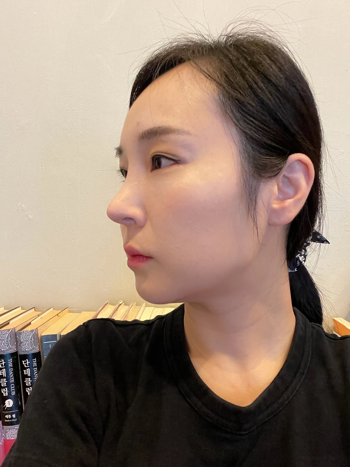 Under-eye fat surgery and Wonder canthoplasty: six-month diary · Case 070 at Answer Plastic Surgery. Additional angled view — 1 month, under-eye fat surgery and wonder canthoplasty at Answer Plastic Surgery (case 070).