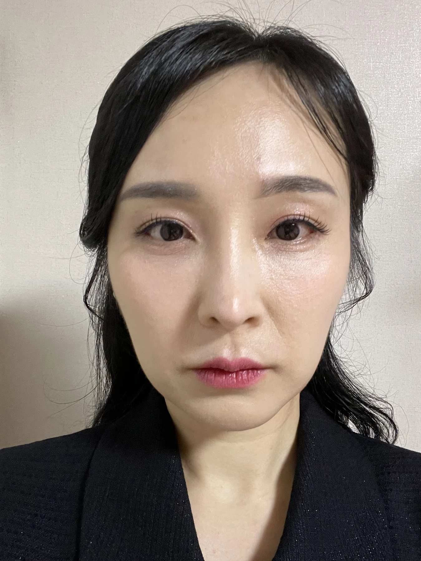 Under-eye fat surgery and Wonder canthoplasty: six-month diary · Case 070 at Answer Plastic Surgery. Front view — 2 months, under-eye fat surgery and wonder canthoplasty at Answer Plastic Surgery (case 070).