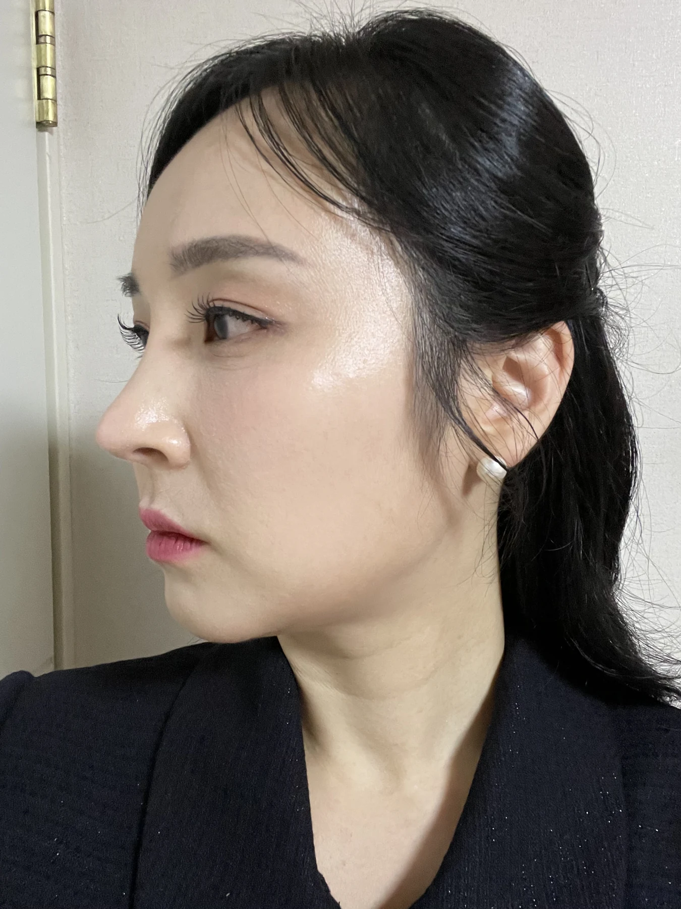 Under-eye fat surgery and Wonder canthoplasty: six-month diary · Case 070 at Answer Plastic Surgery. Angled view — 2 months, under-eye fat surgery and wonder canthoplasty at Answer Plastic Surgery (case 070).