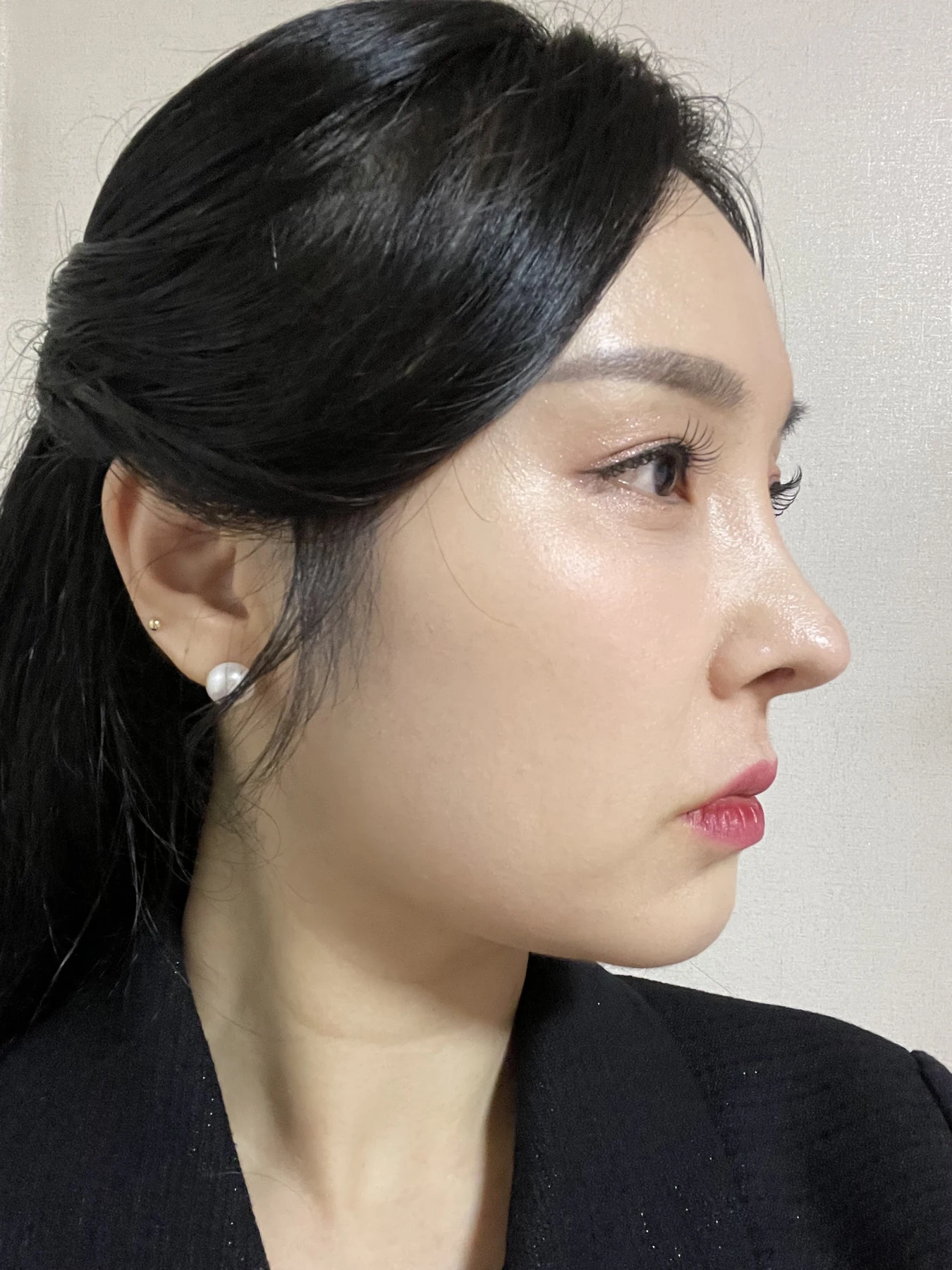 Under-eye fat surgery and Wonder canthoplasty: six-month diary · Case 070 at Answer Plastic Surgery. Additional angled view — 2 months, under-eye fat surgery and wonder canthoplasty at Answer Plastic Surgery (case 070).