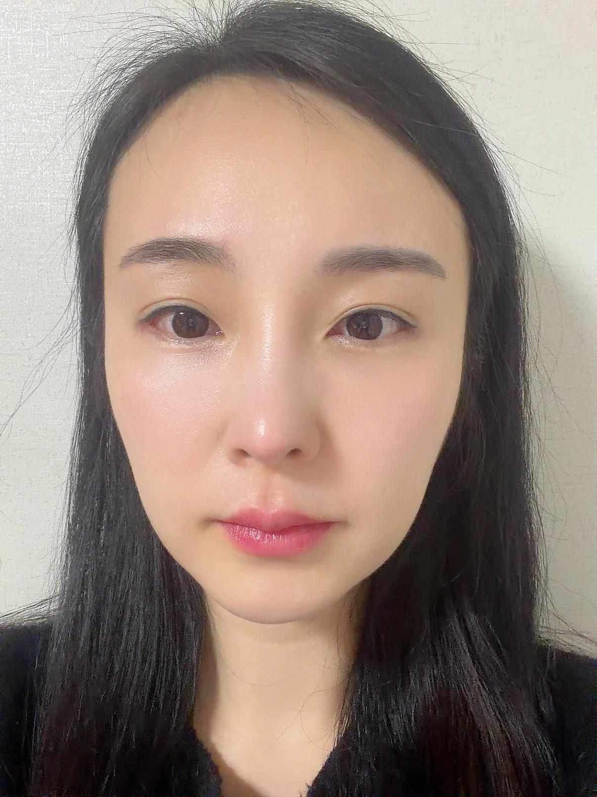 Under-eye fat surgery and Wonder canthoplasty: six-month diary · Case 070 at Answer Plastic Surgery. Front view — 3 months, under-eye fat surgery and wonder canthoplasty at Answer Plastic Surgery (case 070).