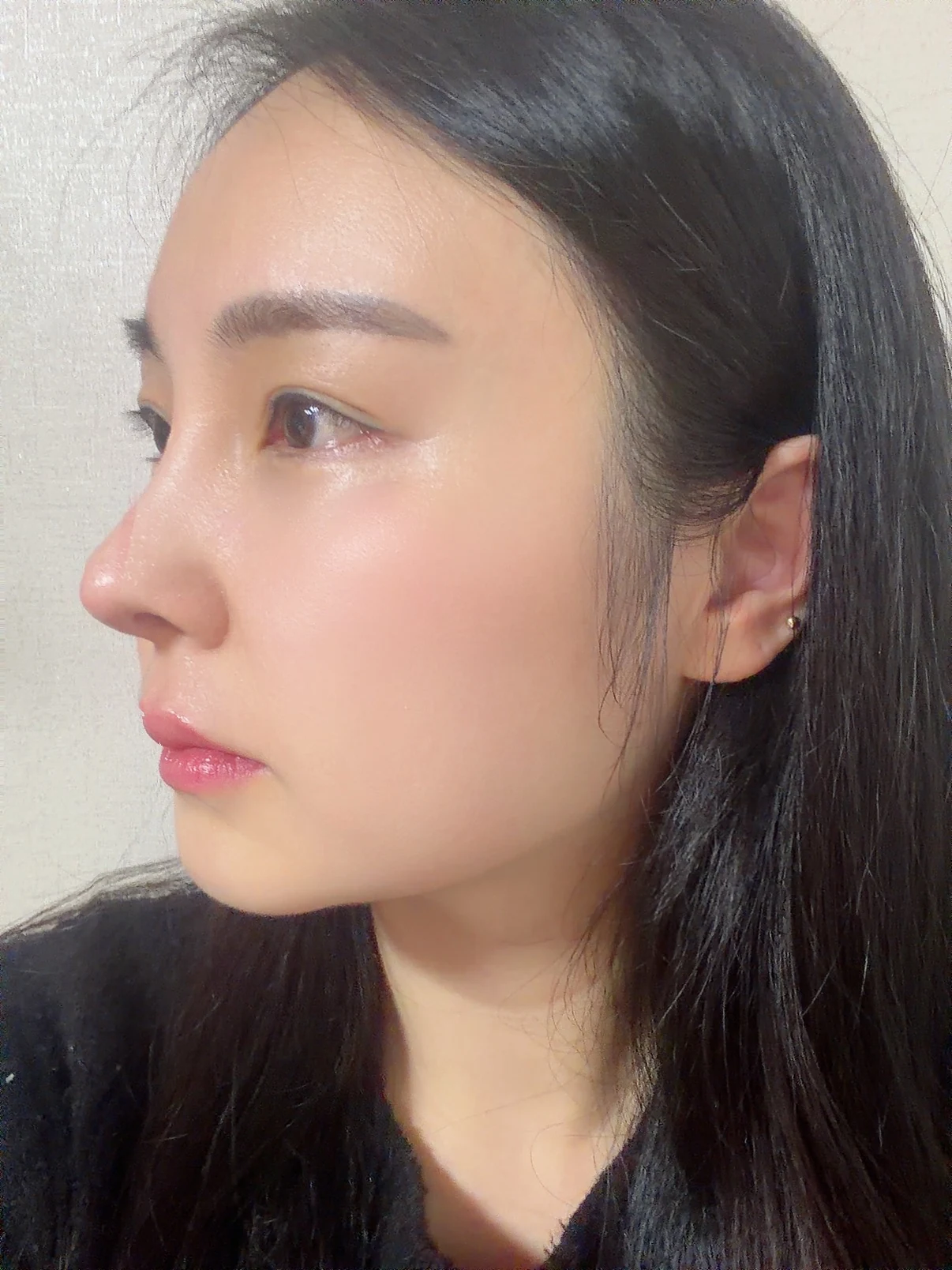 Under-eye fat surgery and Wonder canthoplasty: six-month diary · Case 070 at Answer Plastic Surgery. Angled view — 3 months, under-eye fat surgery and wonder canthoplasty at Answer Plastic Surgery (case 070).