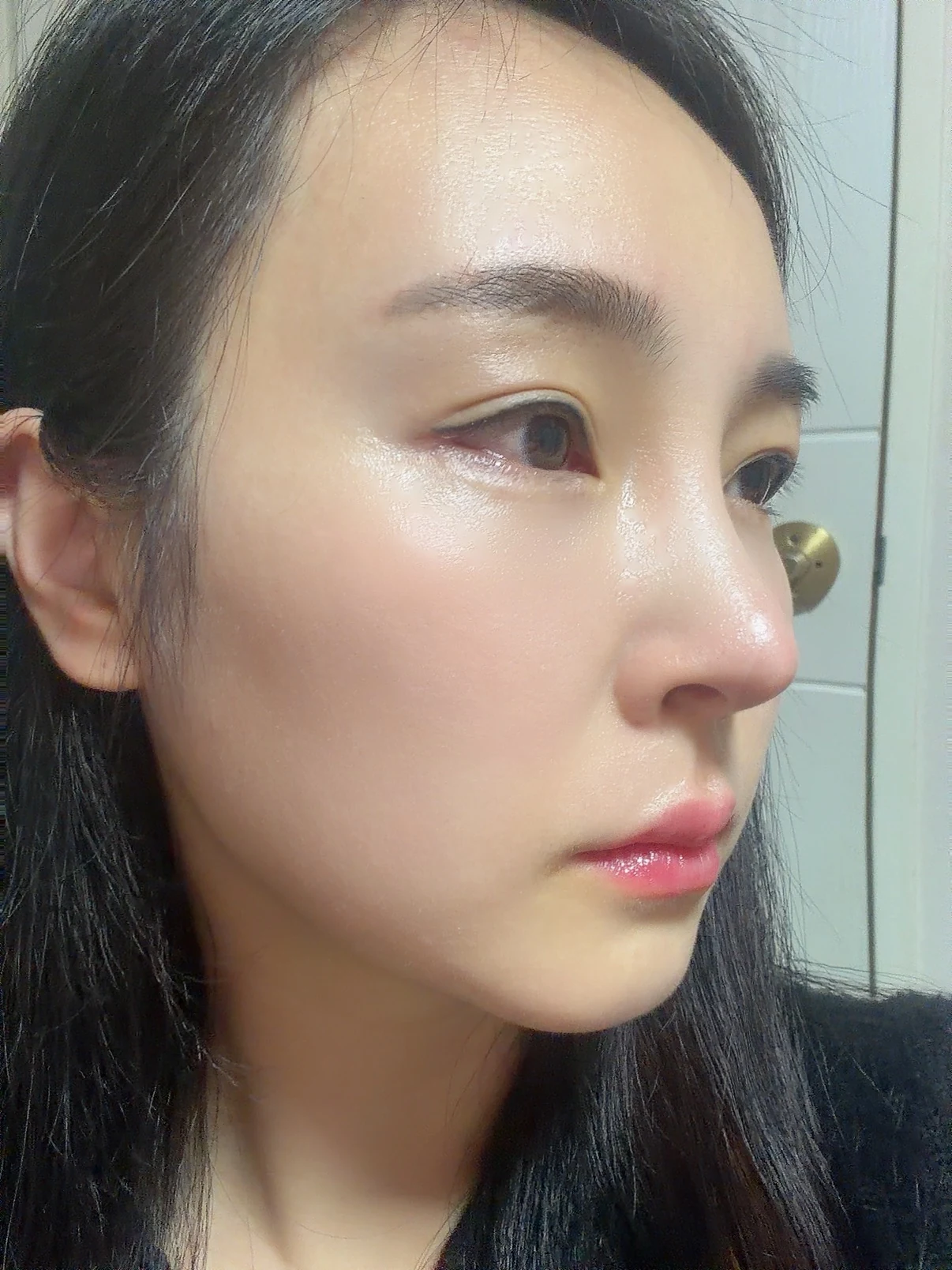 Under-eye fat surgery and Wonder canthoplasty: six-month diary · Case 070 at Answer Plastic Surgery. Additional angled view — 3 months, under-eye fat surgery and wonder canthoplasty at Answer Plastic Surgery (case 070).