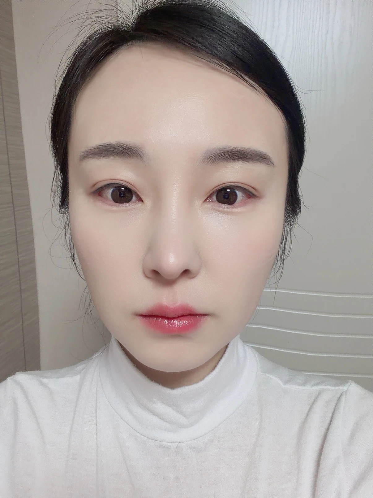 Under-eye fat surgery and Wonder canthoplasty: six-month diary · Case 070 at Answer Plastic Surgery. Front view — 6 months, under-eye fat surgery and wonder canthoplasty at Answer Plastic Surgery (case 070).