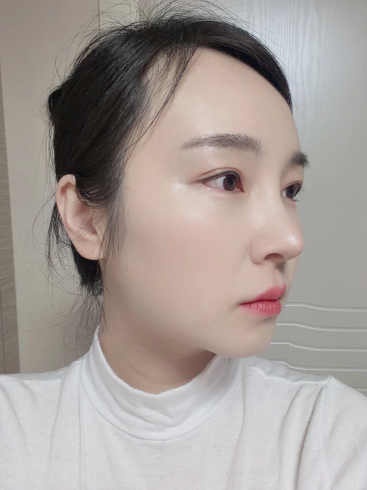Under-eye fat surgery and Wonder canthoplasty: six-month diary · Case 070 at Answer Plastic Surgery. Angled view — 6 months, under-eye fat surgery and wonder canthoplasty at Answer Plastic Surgery (case 070).
