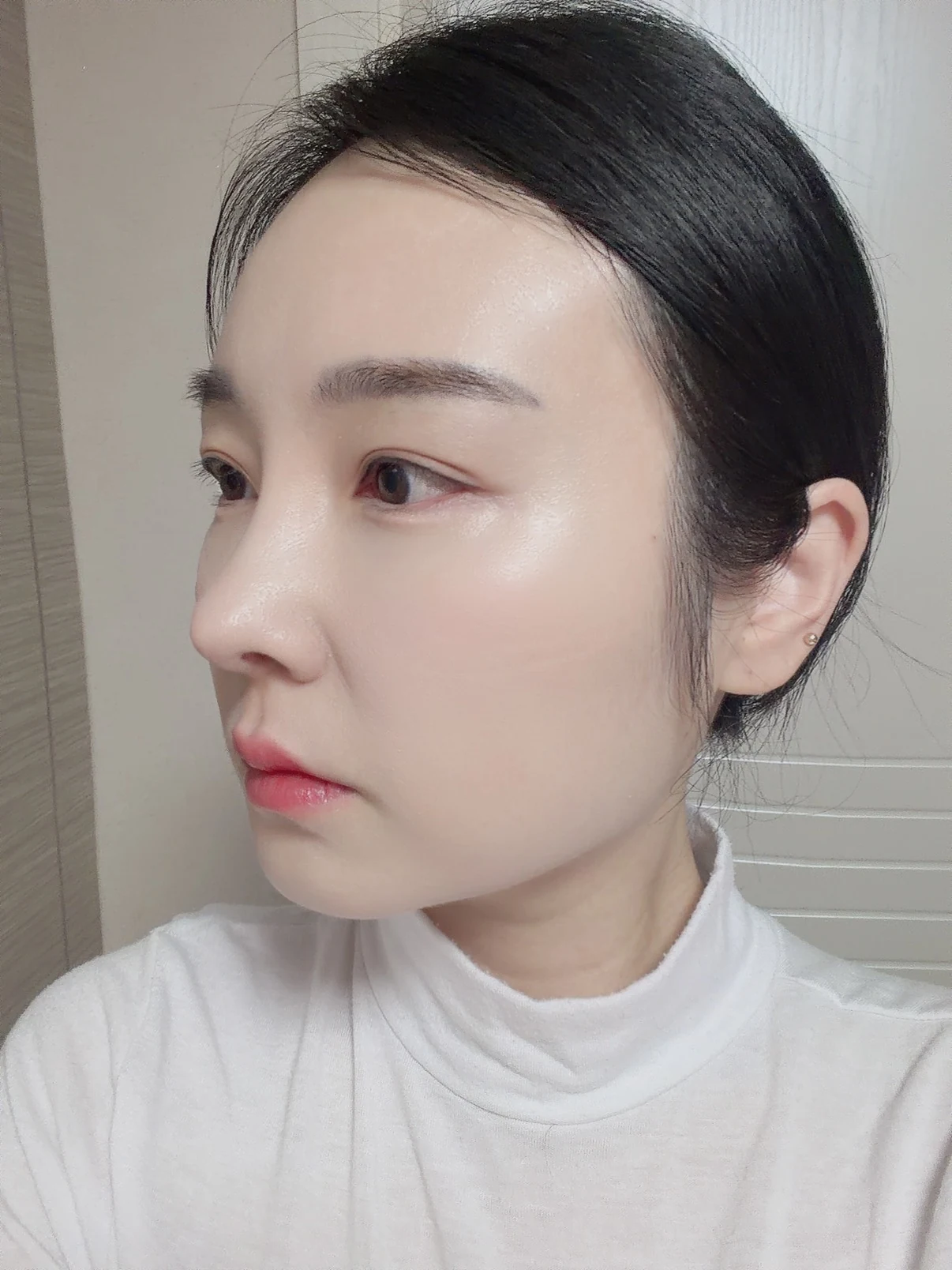 Under-eye fat surgery and Wonder canthoplasty: six-month diary · Case 070 at Answer Plastic Surgery. Additional angled view — 6 months, under-eye fat surgery and wonder canthoplasty at Answer Plastic Surgery (case 070).