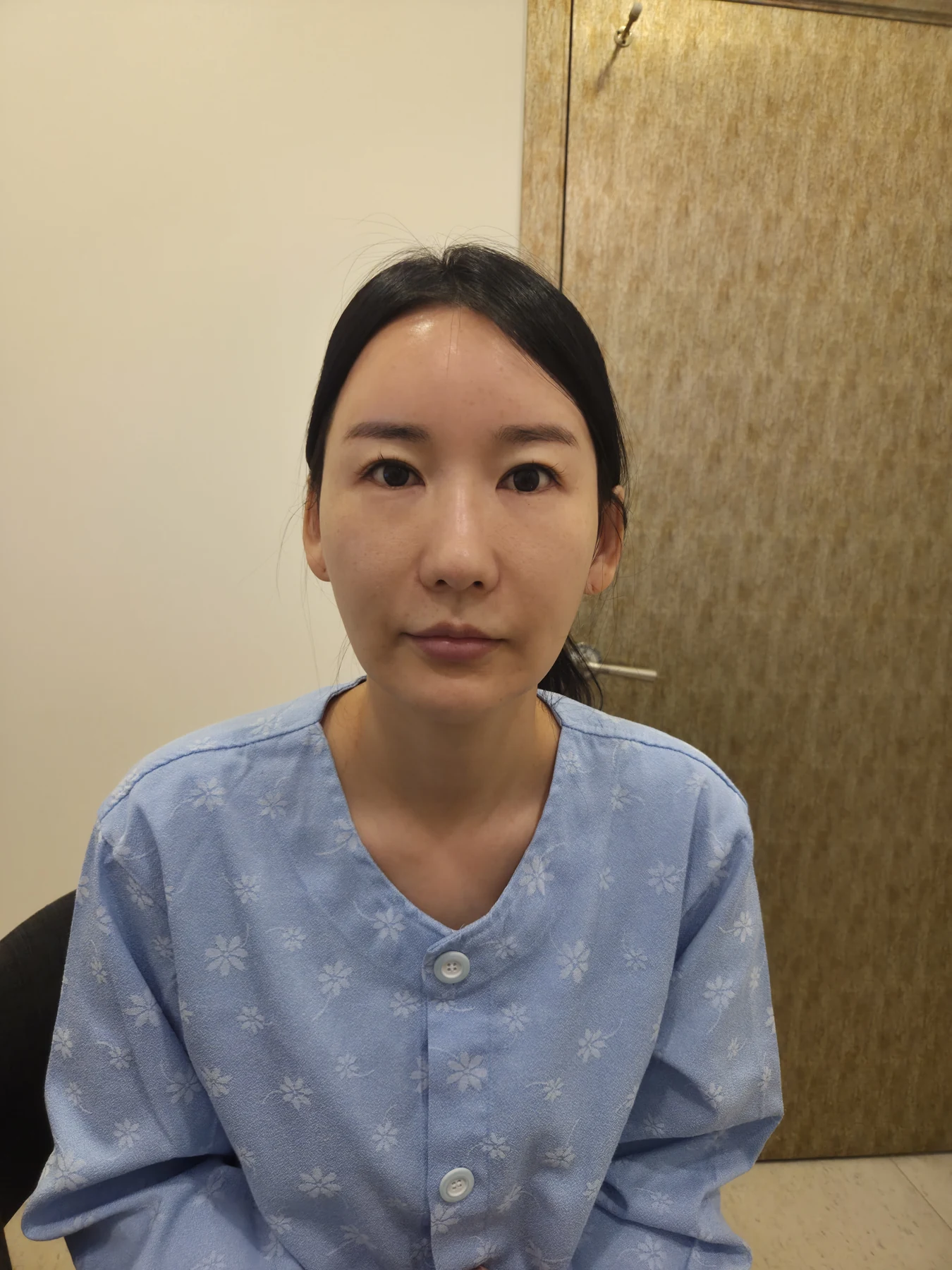 Incisional eyelid revision and eye-corner surgery: three-week recovery · Case 071 at Answer Plastic Surgery. Front view — before, incisional eyelid revision and eye-corner surgery at Answer Plastic Surgery (case 071).