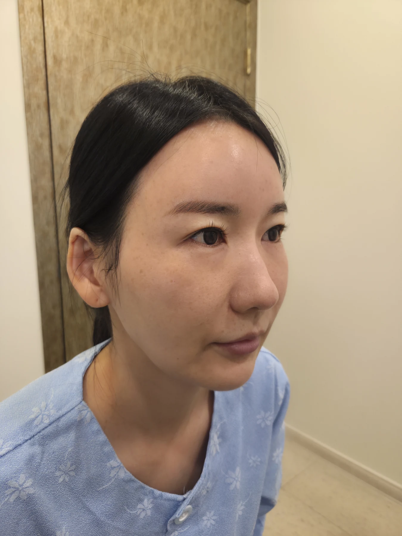 Incisional eyelid revision and eye-corner surgery: three-week recovery · Case 071 at Answer Plastic Surgery. Oblique view — before, incisional eyelid revision and eye-corner surgery at Answer Plastic Surgery (case 071).