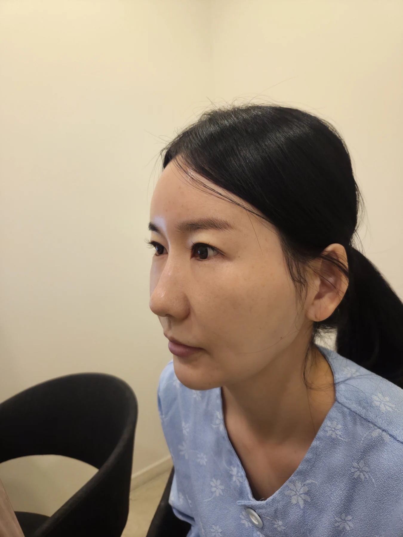 Incisional eyelid revision and eye-corner surgery: three-week recovery · Case 071 at Answer Plastic Surgery. Opposite oblique view — before, incisional eyelid revision and eye-corner surgery at Answer Plastic Surgery (case 071).