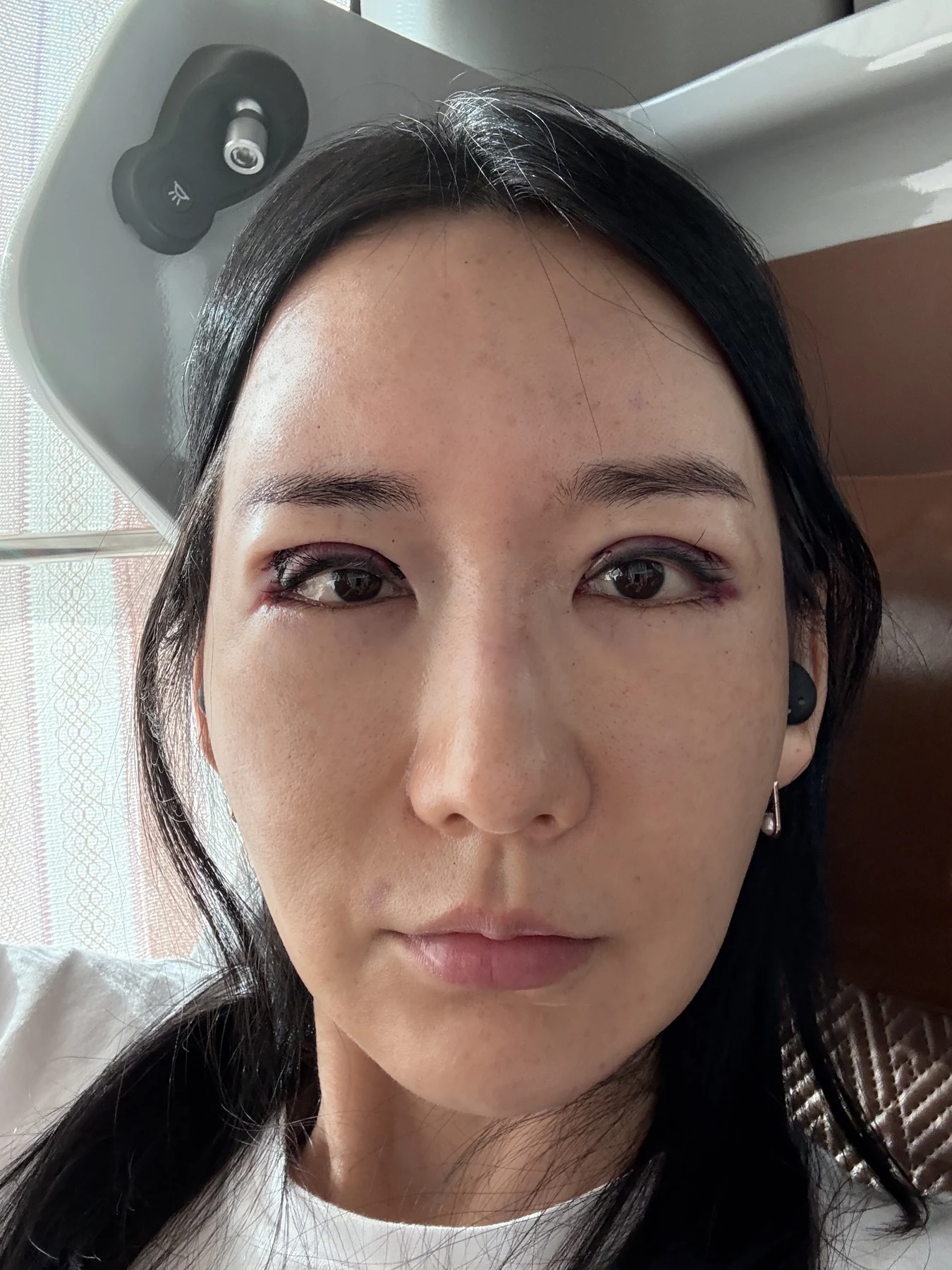 Incisional eyelid revision and eye-corner surgery: three-week recovery · Case 071 at Answer Plastic Surgery. Front view — surgery day, incisional eyelid revision and eye-corner surgery at Answer Plastic Surgery (case 071).