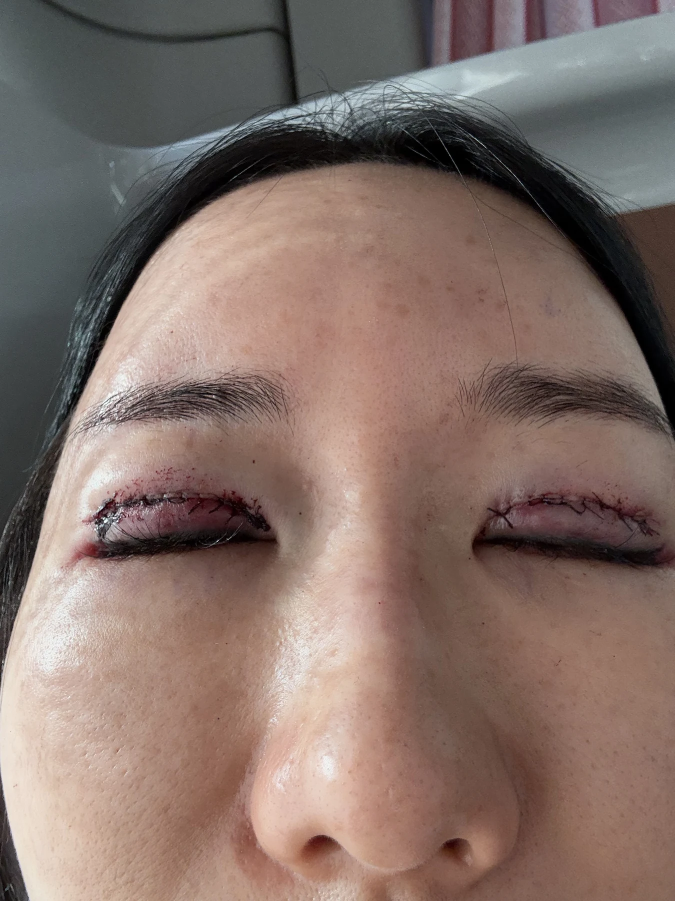 Incisional eyelid revision and eye-corner surgery: three-week recovery · Case 071 at Answer Plastic Surgery. Closed-eyelid close-up — surgery day, incisional eyelid revision and eye-corner surgery at Answer Plastic Surgery (case 071).