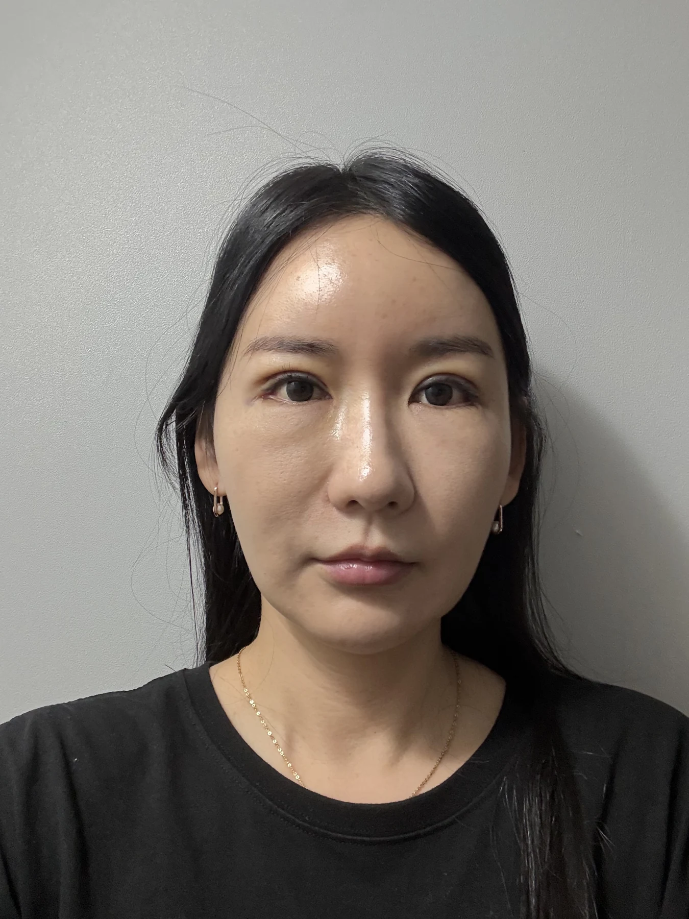 Incisional eyelid revision and eye-corner surgery: three-week recovery · Case 071 at Answer Plastic Surgery. Front view — 1 week after surgery, incisional eyelid revision and eye-corner surgery at Answer Plastic Surgery (case 071).