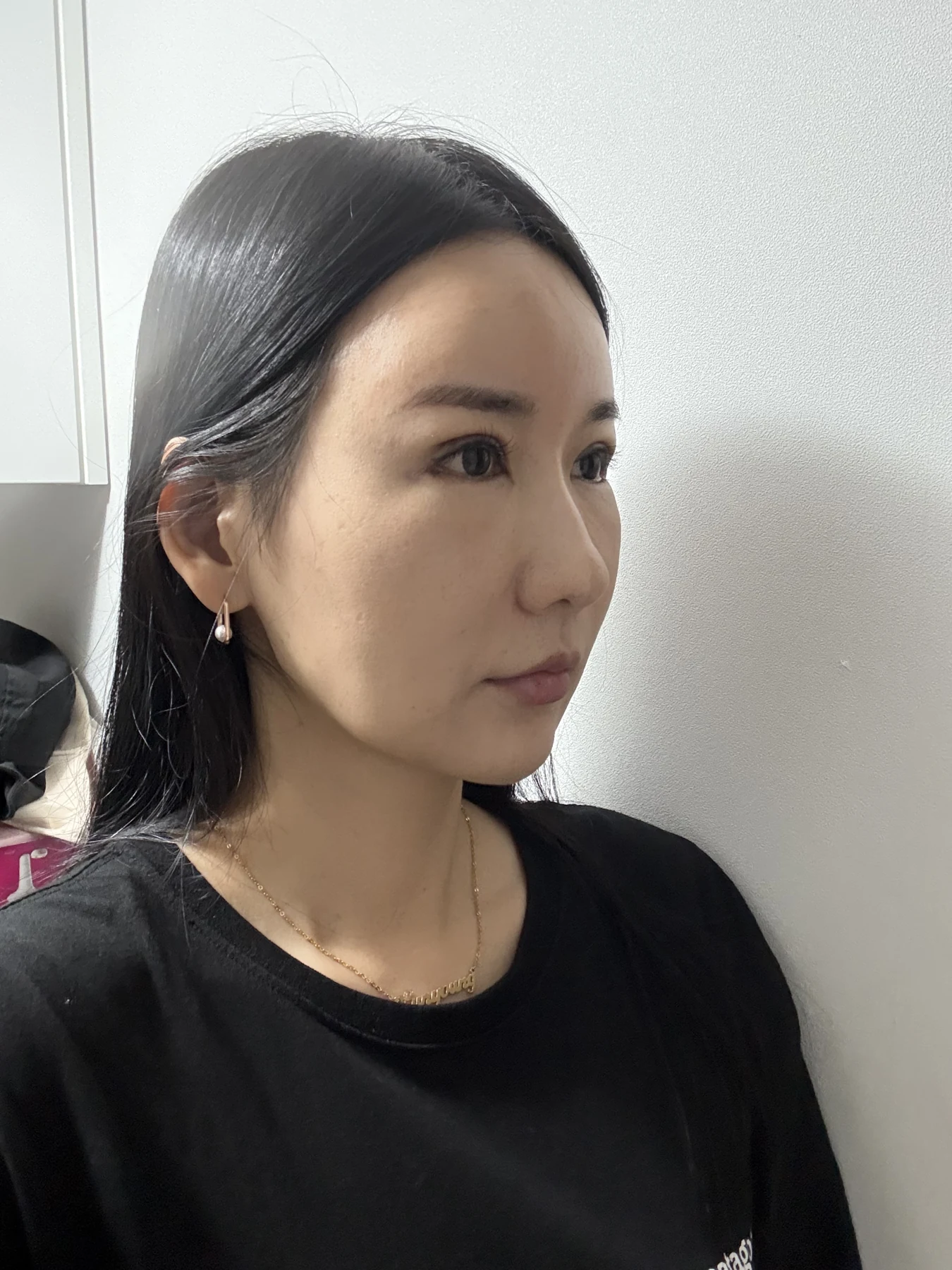 Incisional eyelid revision and eye-corner surgery: three-week recovery · Case 071 at Answer Plastic Surgery. Oblique view — 1 week after surgery, incisional eyelid revision and eye-corner surgery at Answer Plastic Surgery (case 071).
