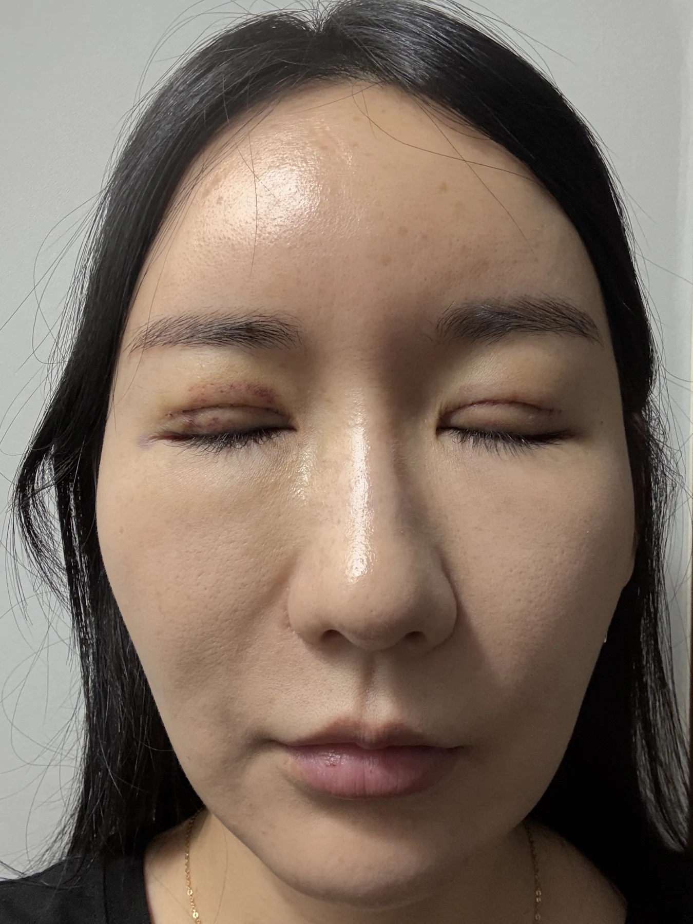 Incisional eyelid revision and eye-corner surgery: three-week recovery · Case 071 at Answer Plastic Surgery. Closed-eyelid view — 1 week after surgery, incisional eyelid revision and eye-corner surgery at Answer Plastic Surgery (case 071).