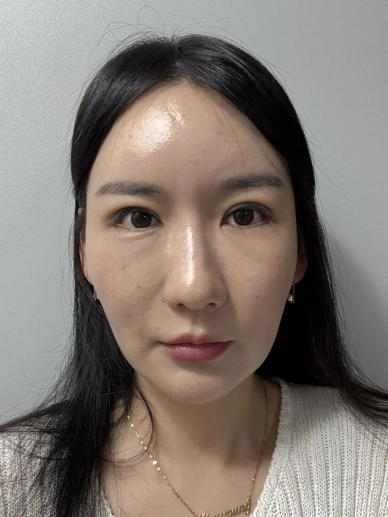 Incisional eyelid revision and eye-corner surgery: three-week recovery · Case 071 at Answer Plastic Surgery. Front view — 2 weeks after surgery, incisional eyelid revision and eye-corner surgery at Answer Plastic Surgery (case 071).