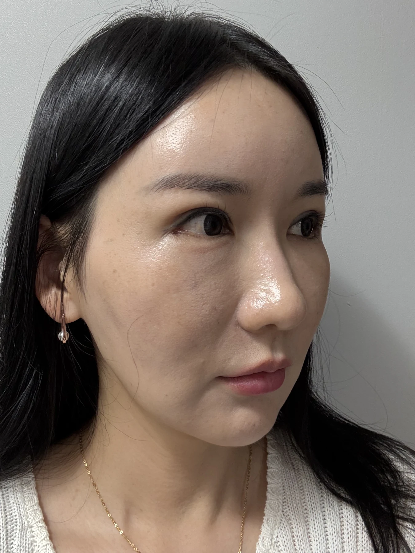 Incisional eyelid revision and eye-corner surgery: three-week recovery · Case 071 at Answer Plastic Surgery. Oblique view — 2 weeks after surgery, incisional eyelid revision and eye-corner surgery at Answer Plastic Surgery (case 071).