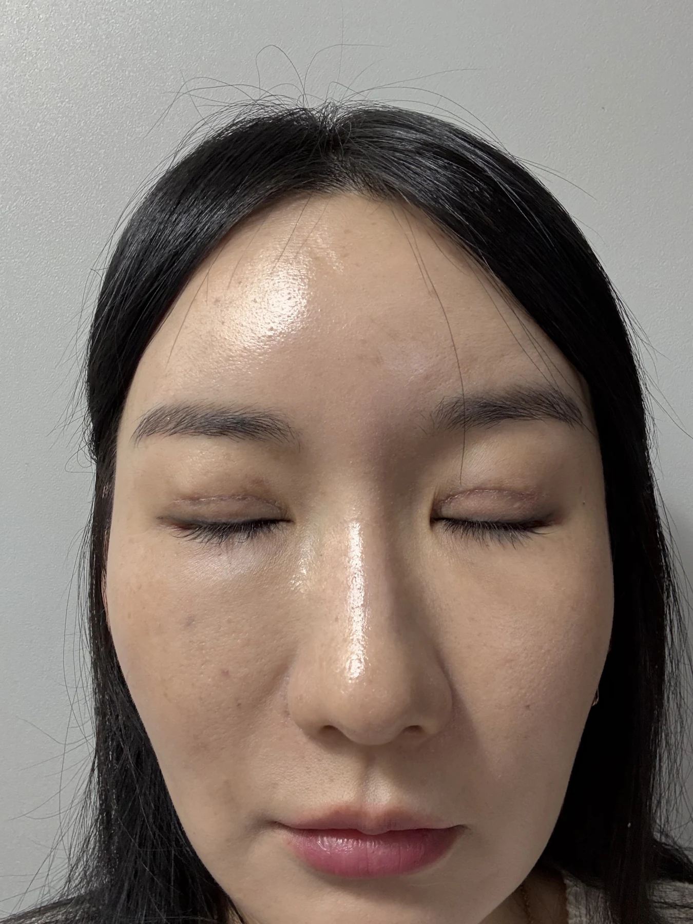 Incisional eyelid revision and eye-corner surgery: three-week recovery · Case 071 at Answer Plastic Surgery. Closed-eyelid view — 2 weeks after surgery, incisional eyelid revision and eye-corner surgery at Answer Plastic Surgery (case 071).