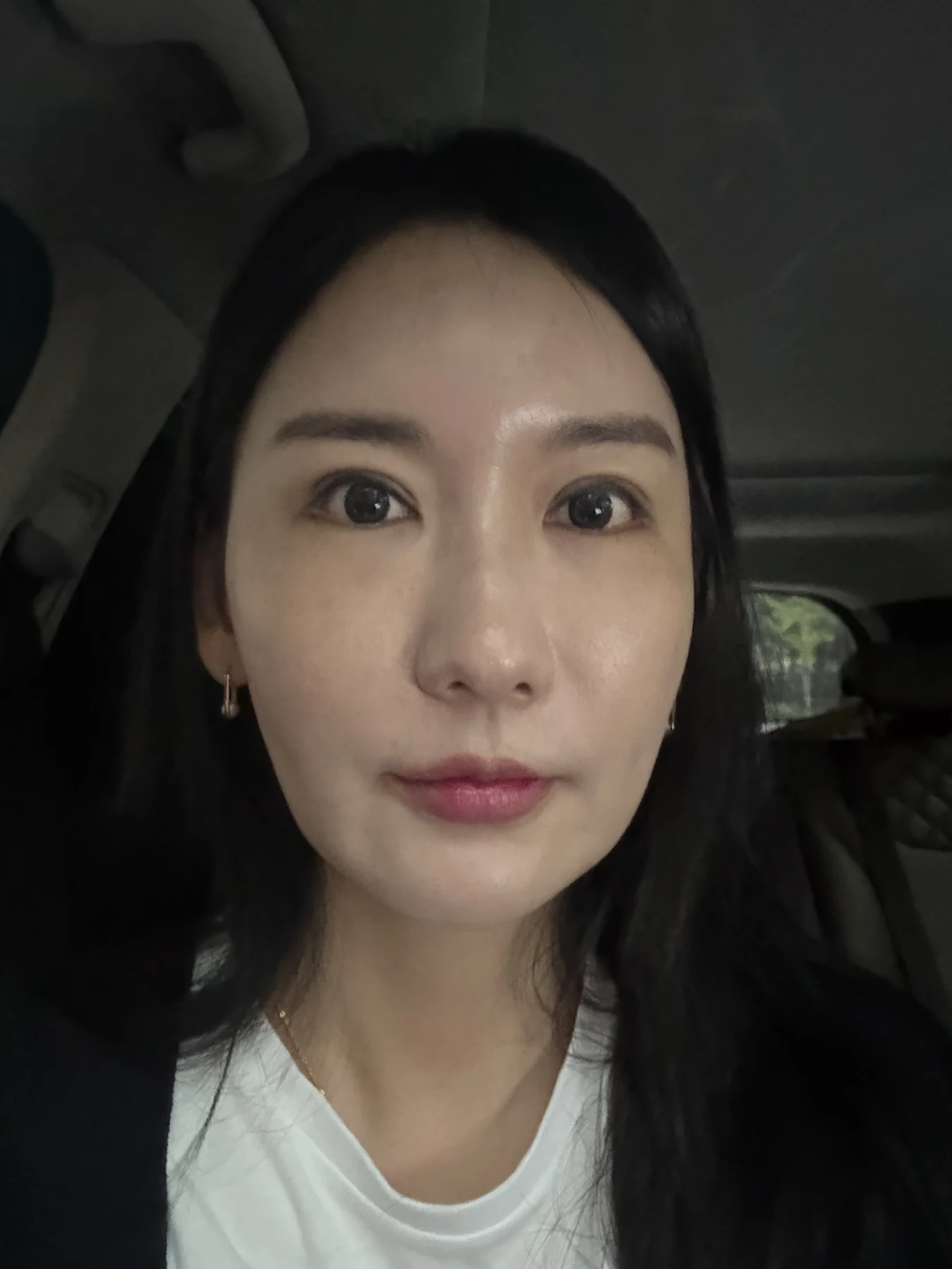 Incisional eyelid revision and eye-corner surgery: three-week recovery · Case 071 at Answer Plastic Surgery. Front portrait — 3 weeks after surgery, incisional eyelid revision and eye-corner surgery at Answer Plastic Surgery (case 071).